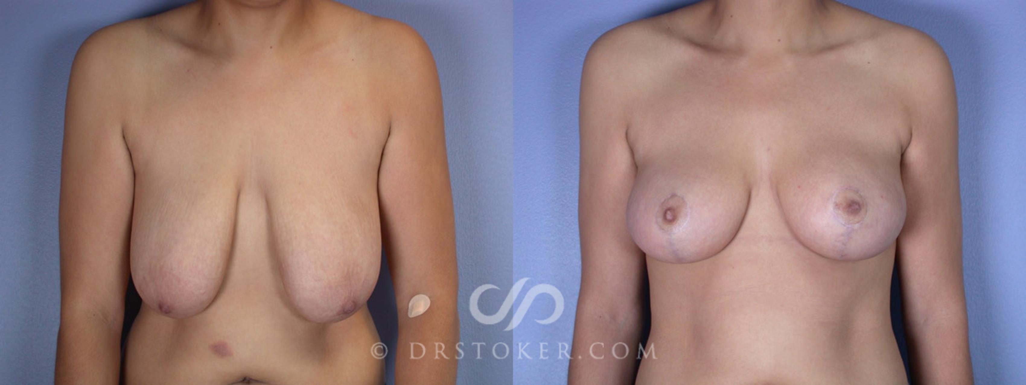 Before & After Breast Lift Case 199 View #1 View in Los Angeles, CA