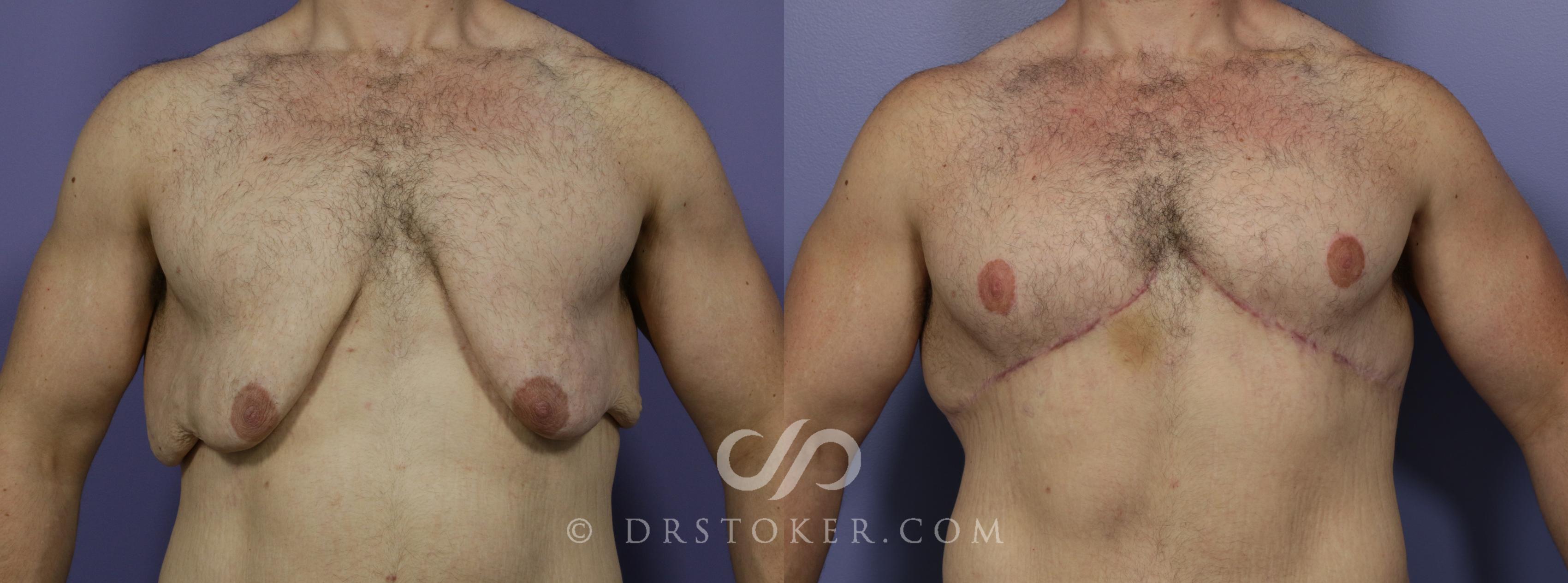 Before & After Breast Reduction for Men (Gynecomastia) Case 723 View #1 View in Los Angeles, CA