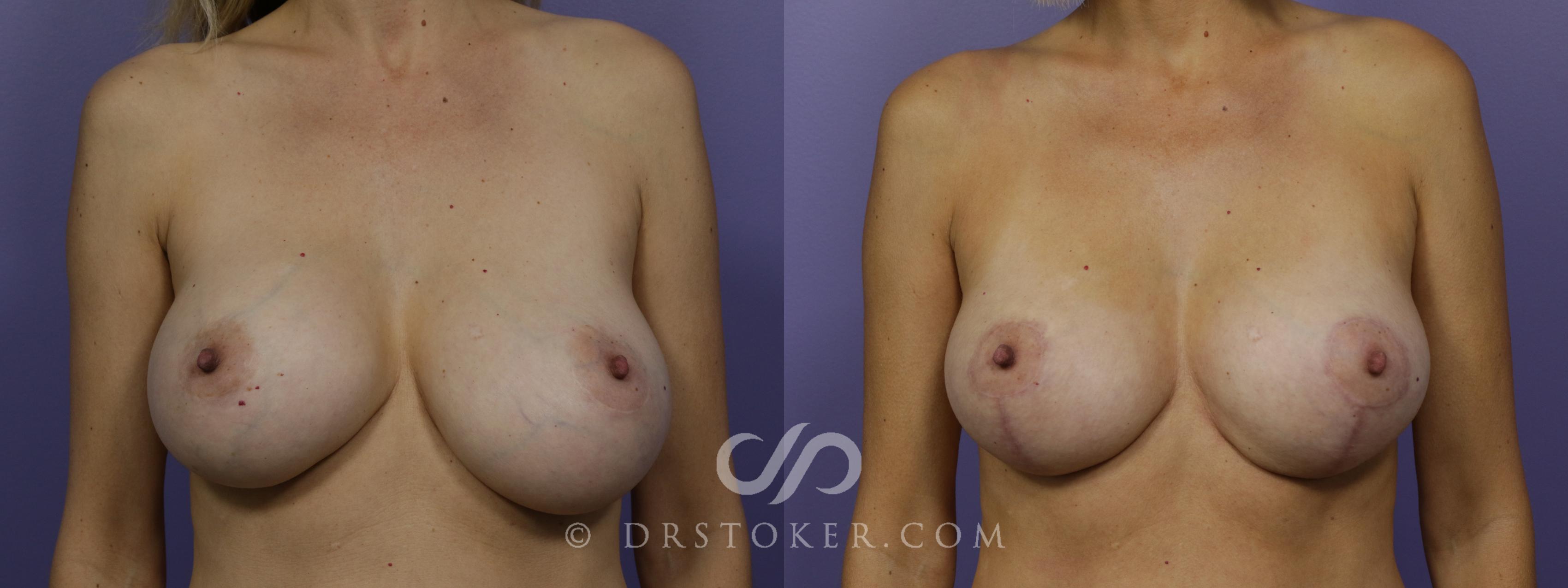 Before & After Breast Augmentation with Lift Case 1523 View #1 View in Los Angeles, CA