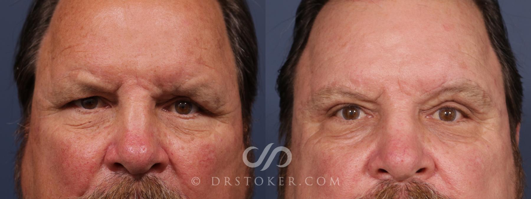 Before & After Brow Lift Case 2661 Front View in Los Angeles, CA