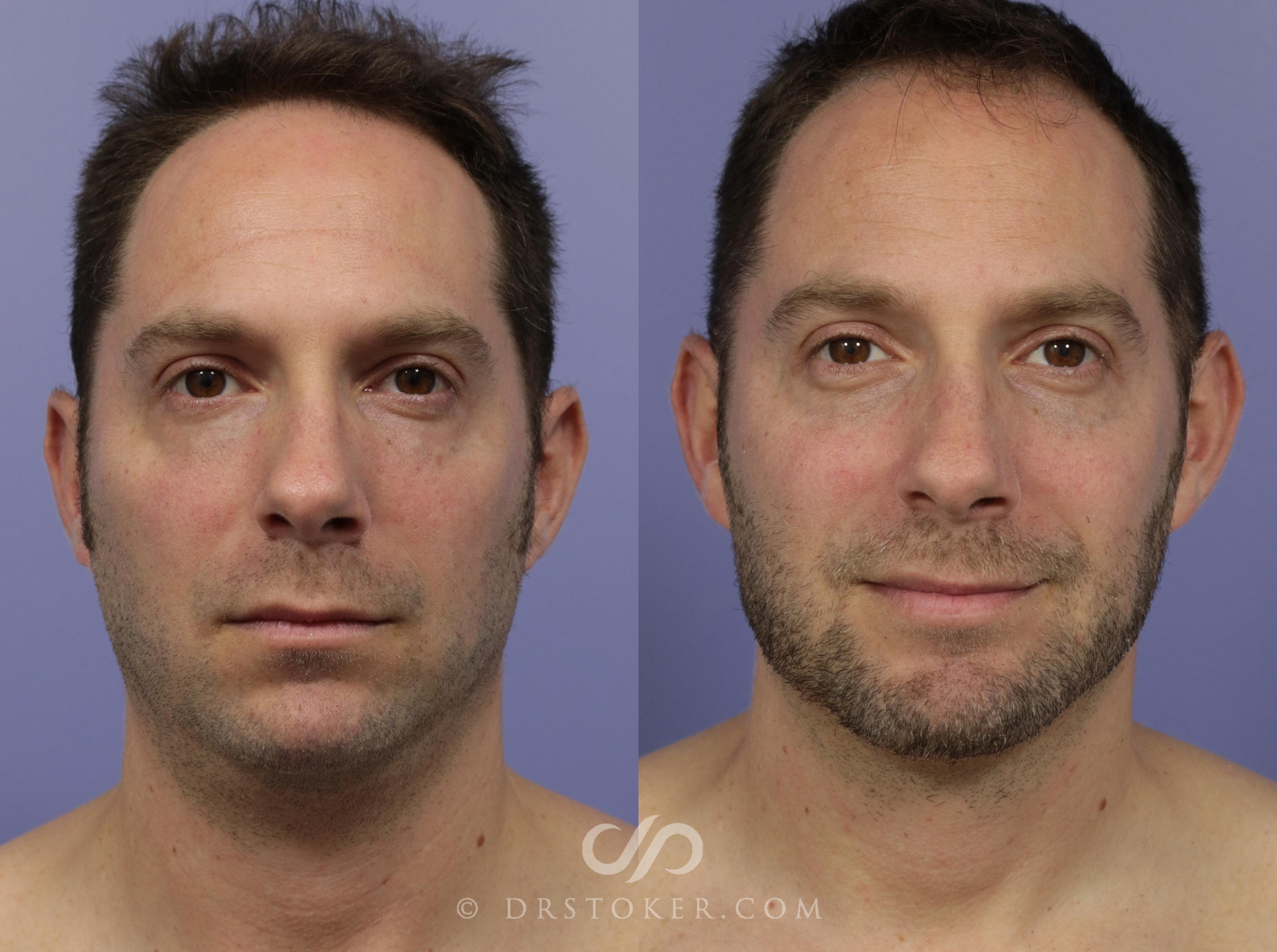Before & After Liposuction - Neck Case 1163 View #1 View in Los Angeles, CA