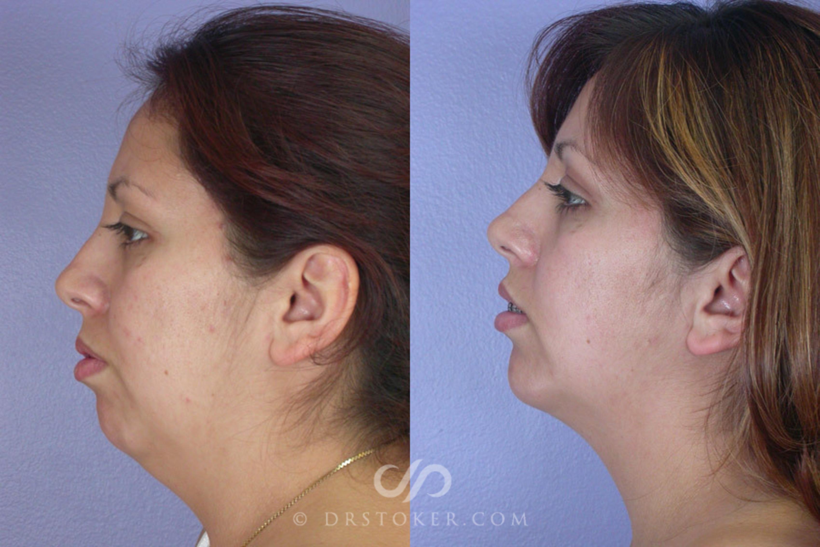 Before & After Liposuction - Neck Case 259 View #1 View in Los Angeles, CA