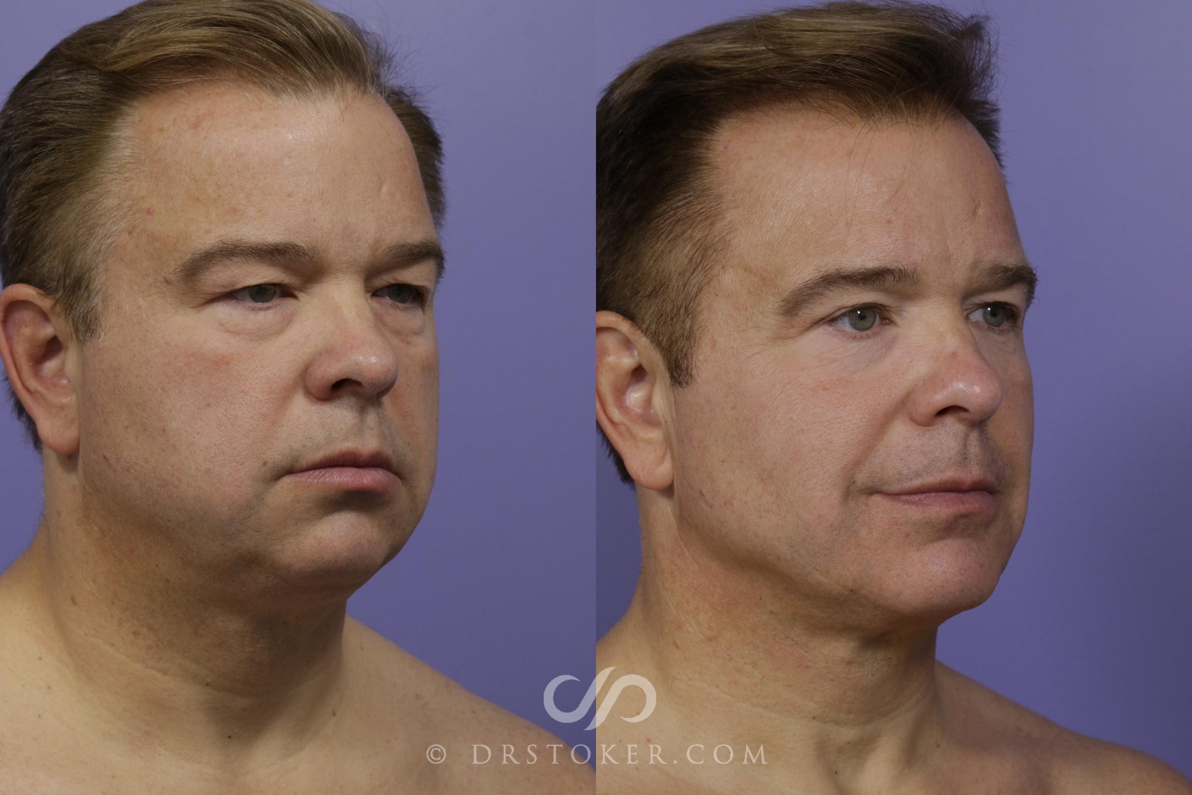 Liposuction - Neck Case 1524 Before & After View #1 | Marina del Rey, CA | Dr. David Stoker