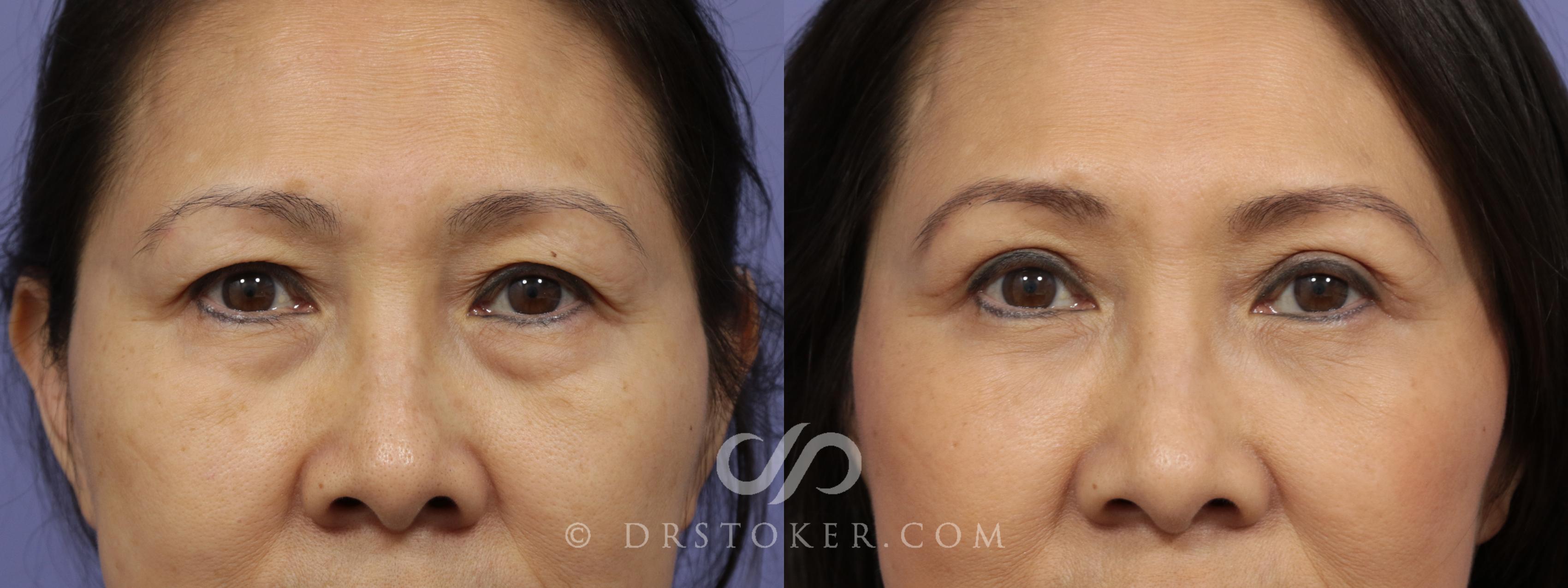 Before & After Eyelid Surgery Case 1417 View #1 View in Los Angeles, CA