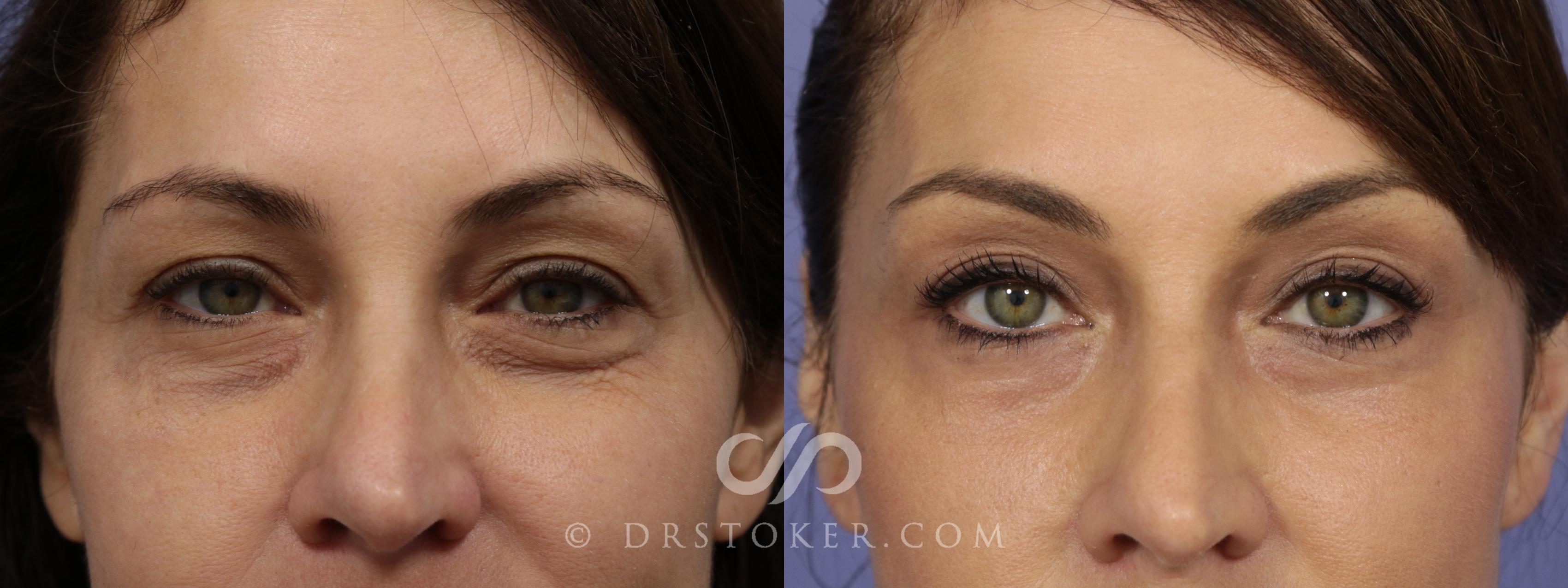 Before & After Eyelid Surgery Case 848 View #1 View in Los Angeles, CA