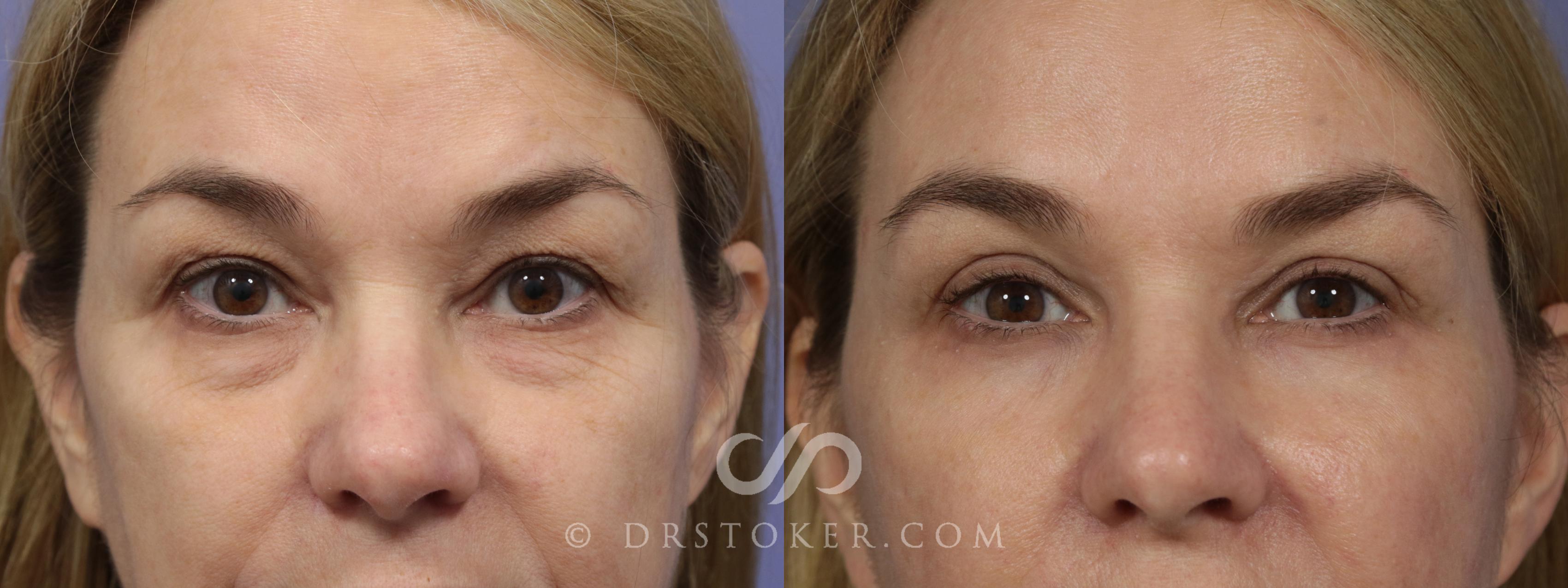 Before & After Eyelid Surgery Case 866 View #1 View in Los Angeles, CA