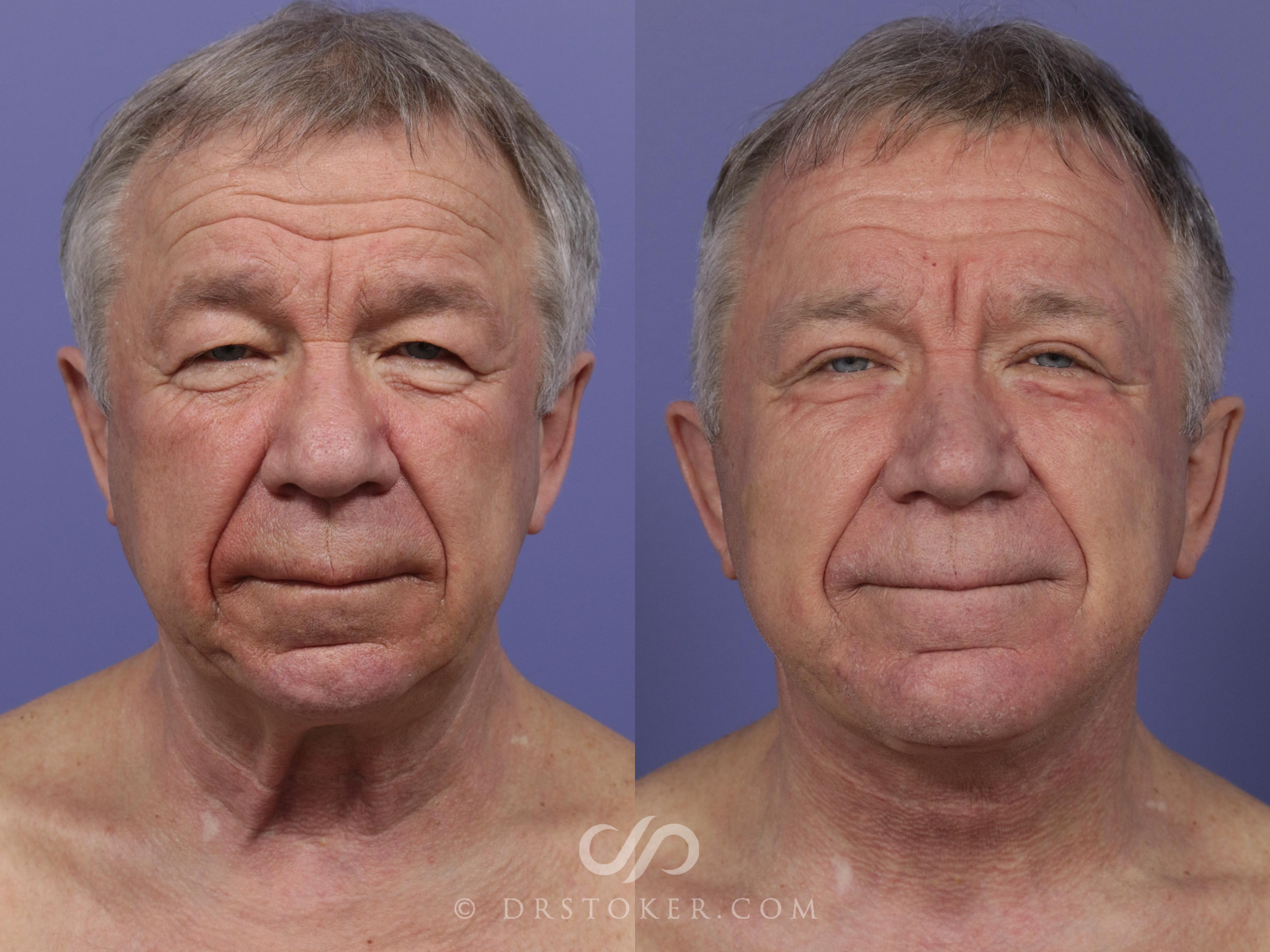 Before & After Neck Lift for Men Case 823 View #1 View in Los Angeles, CA