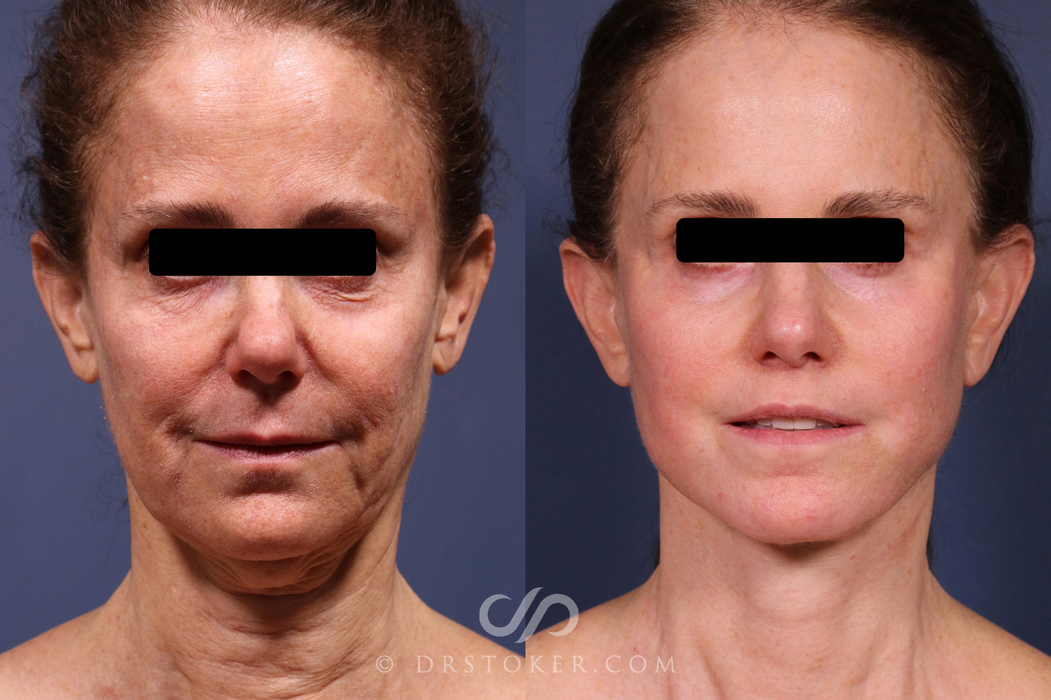 Before & After Facelift - Traceless Facelift Case 2373 Front View in Los Angeles, CA
