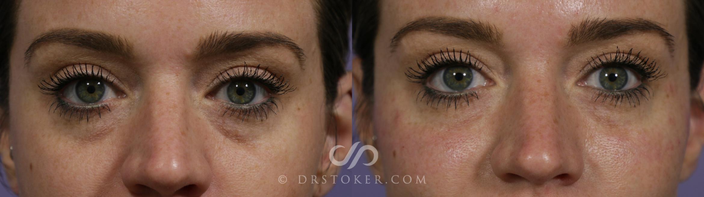 Before & After Facial Fillers Case 1621 View #1 View in Marina del Rey, CA