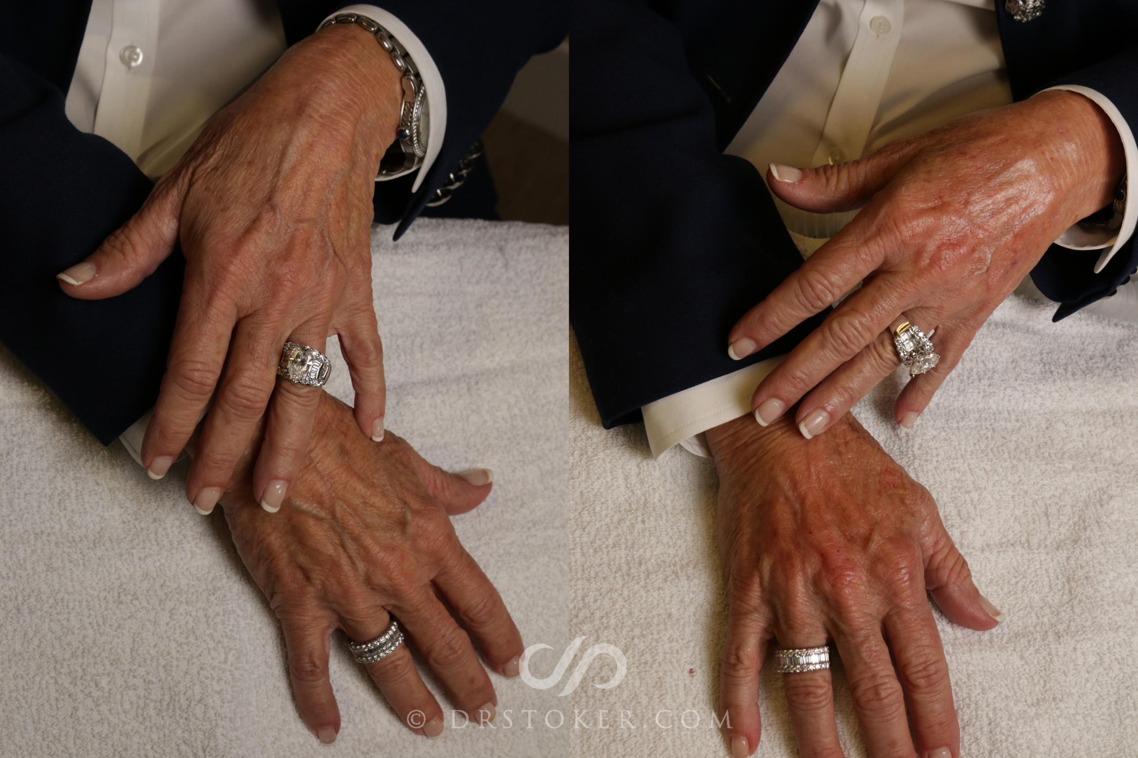 Filler-Hands Case 1647 Before & After View #1 | Marina del Rey, CA | Dr. David Stoker