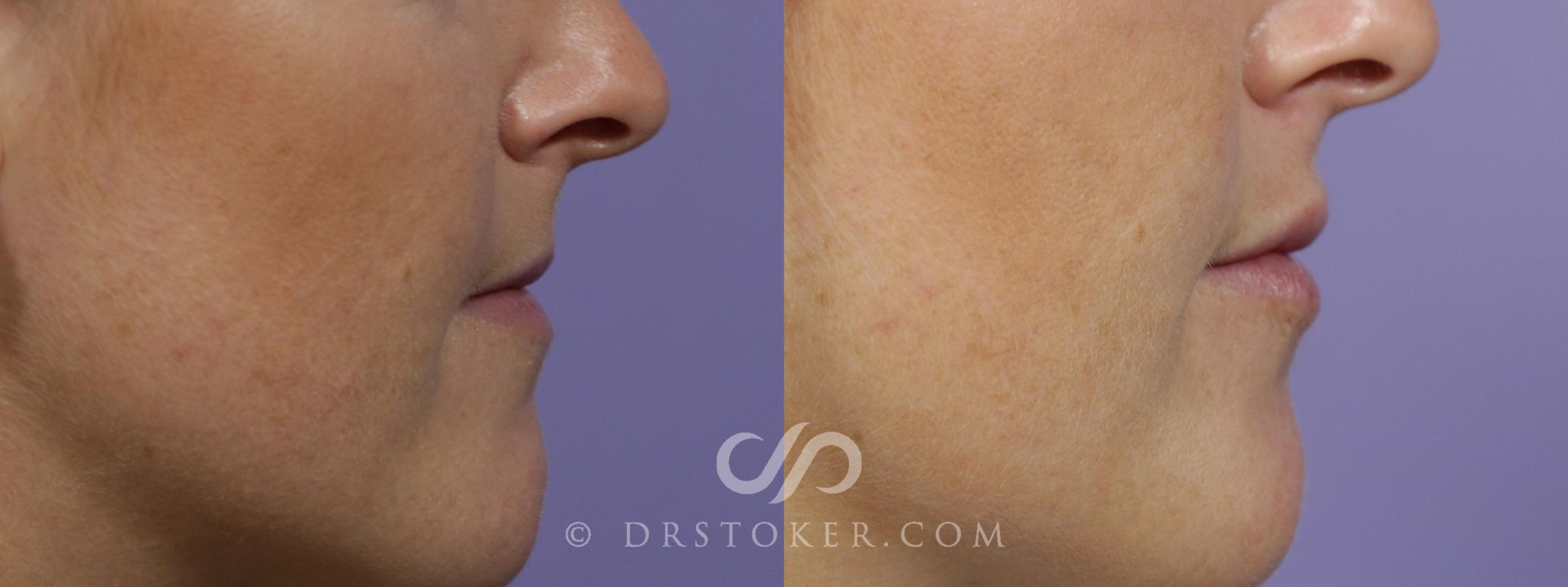 Filler-Lips Case 1602 Before & After View #1 | Marina del Rey, CA | Dr. David Stoker