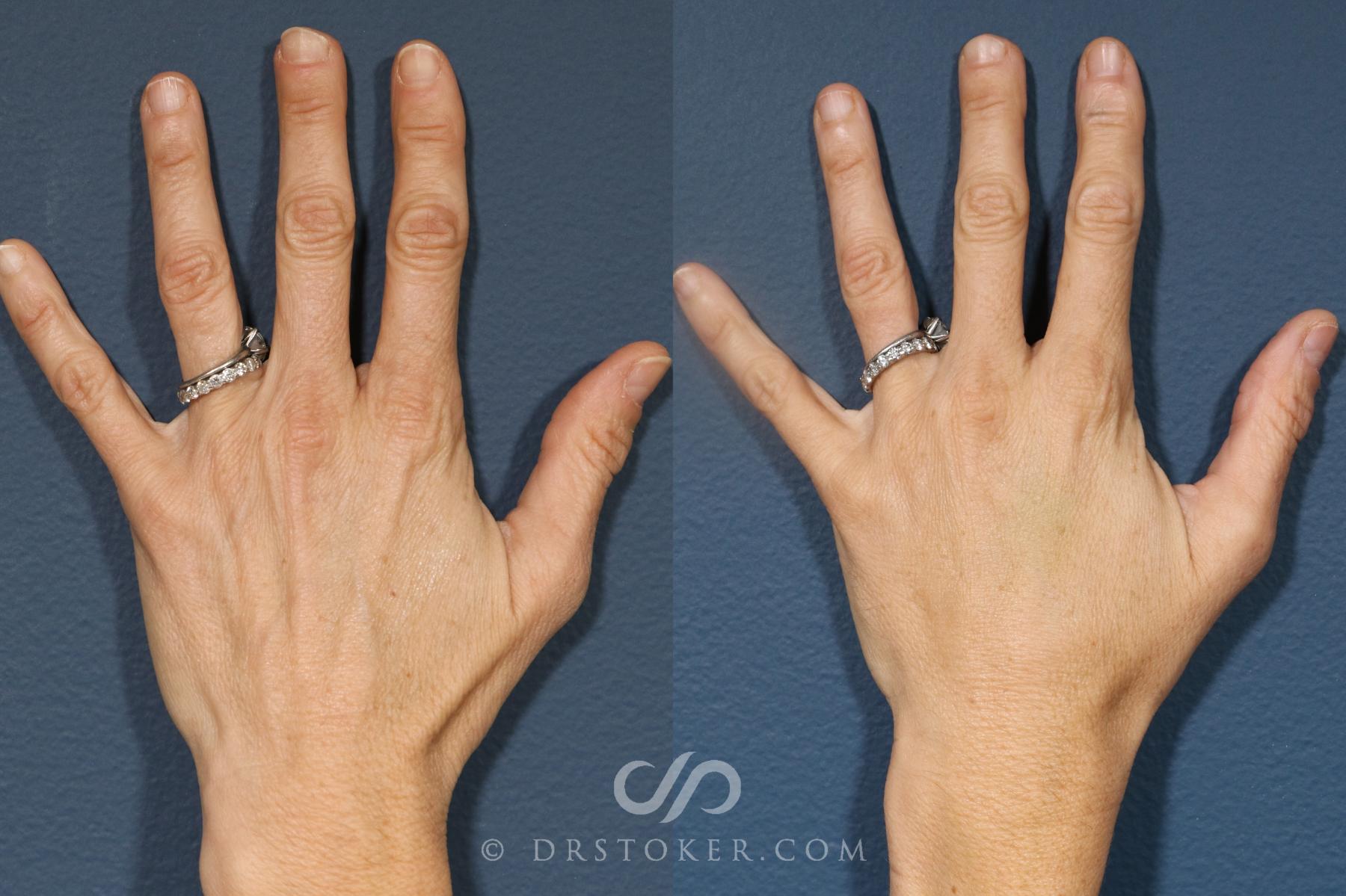 Before & After Hand Fillers Case 2701 Front View in Los Angeles, CA