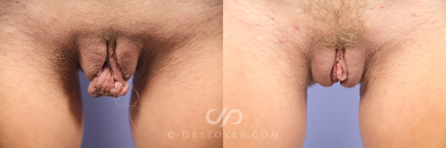Before & After Labiaplasty Case 481 View #1 View in Los Angeles, CA