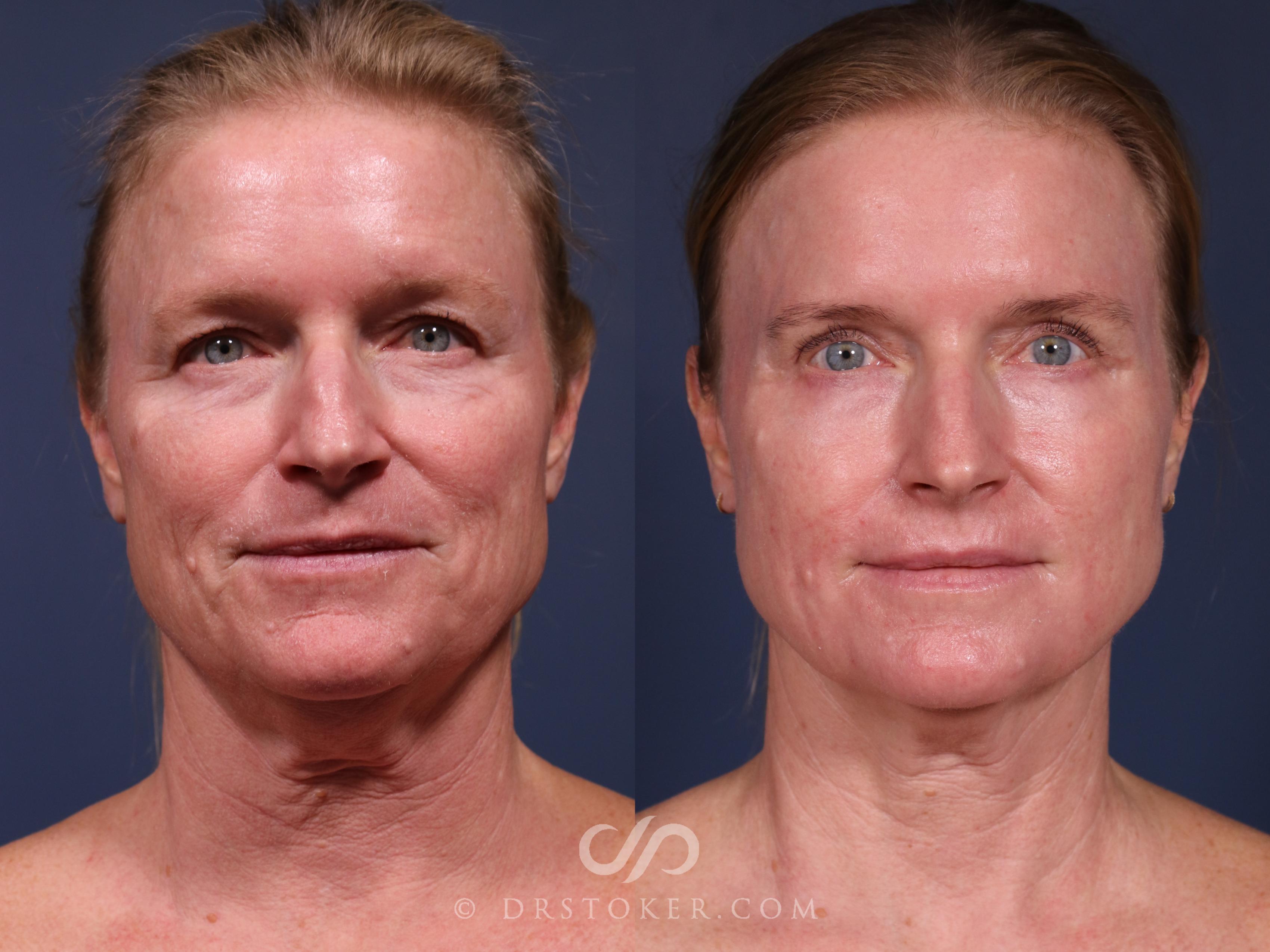 Before & After Laser Skin Resurfacing Case 2561 Full Face View in Los Angeles, CA