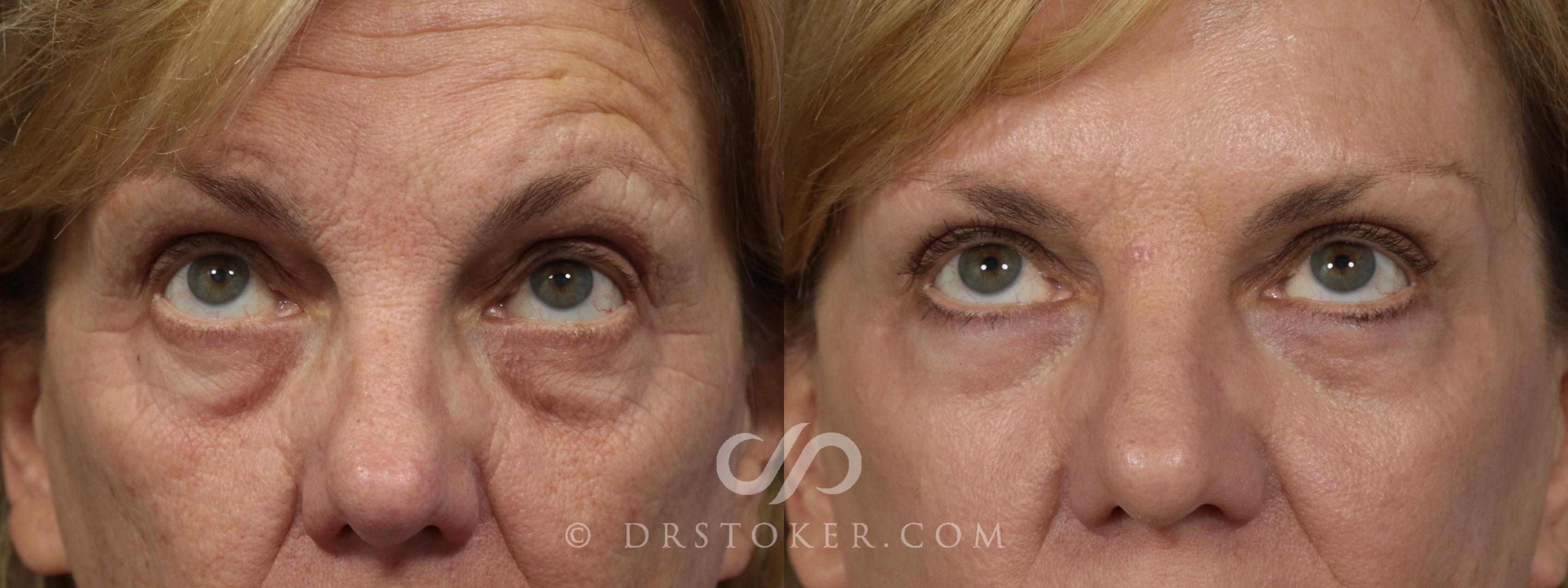 Before & After Laser Skin Resurfacing Case 923 View #1 View in Los Angeles, CA