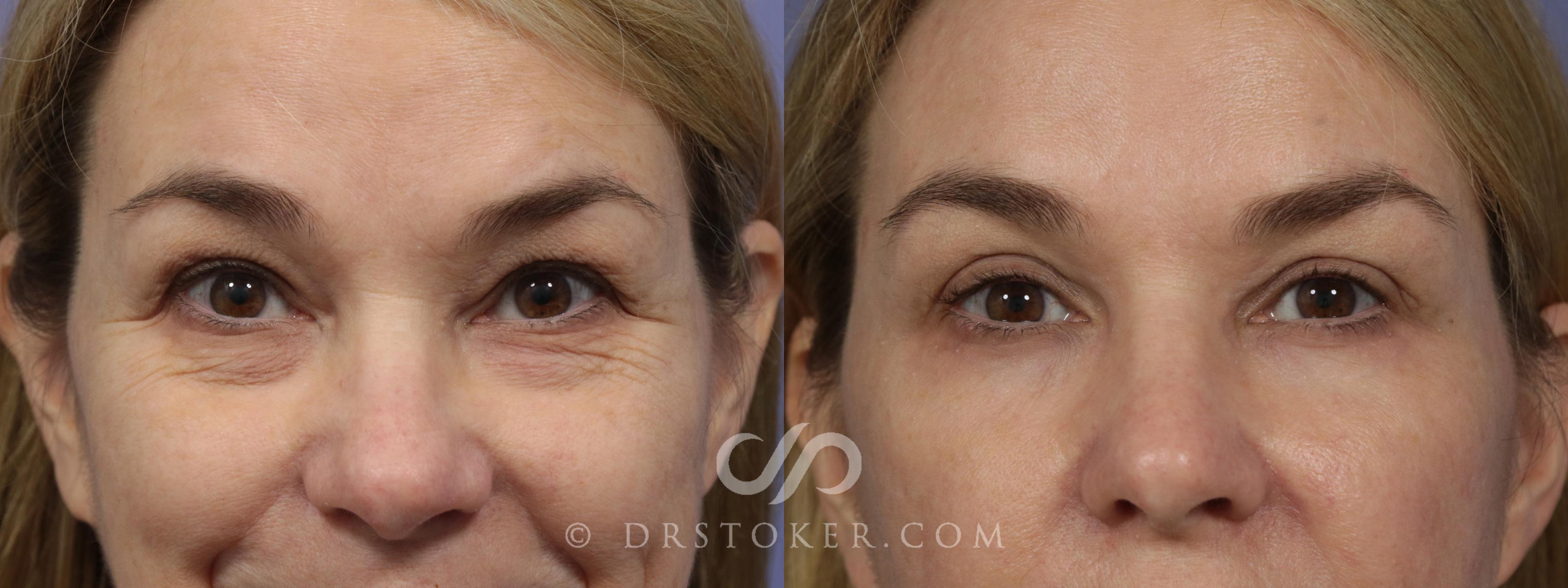Before & After Laser Skin Resurfacing Case 931 View #1 View in Los Angeles, CA