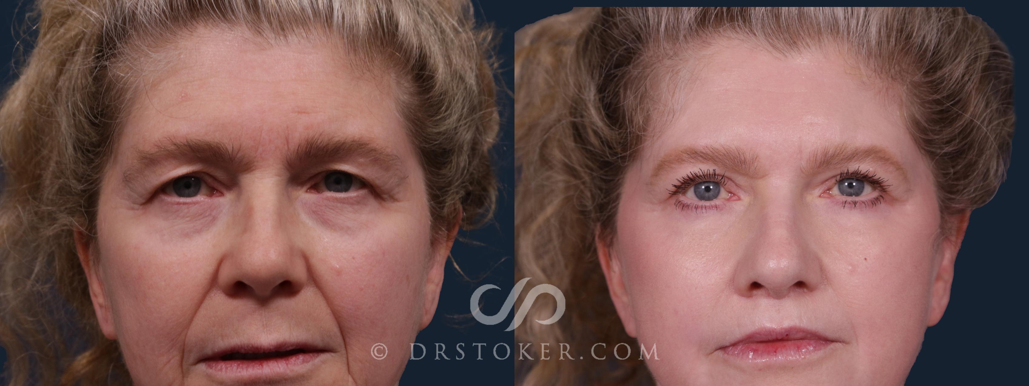 Before & After Laser Skin Resurfacing Eyes Case 2207 Front View in Los Angeles, CA