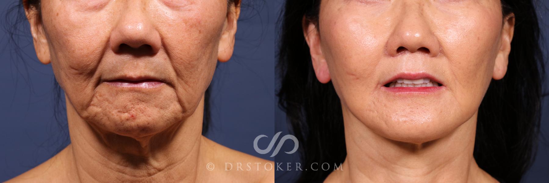 Before & After Asian Plastic Surgery Case 2622 Front View in Los Angeles, CA