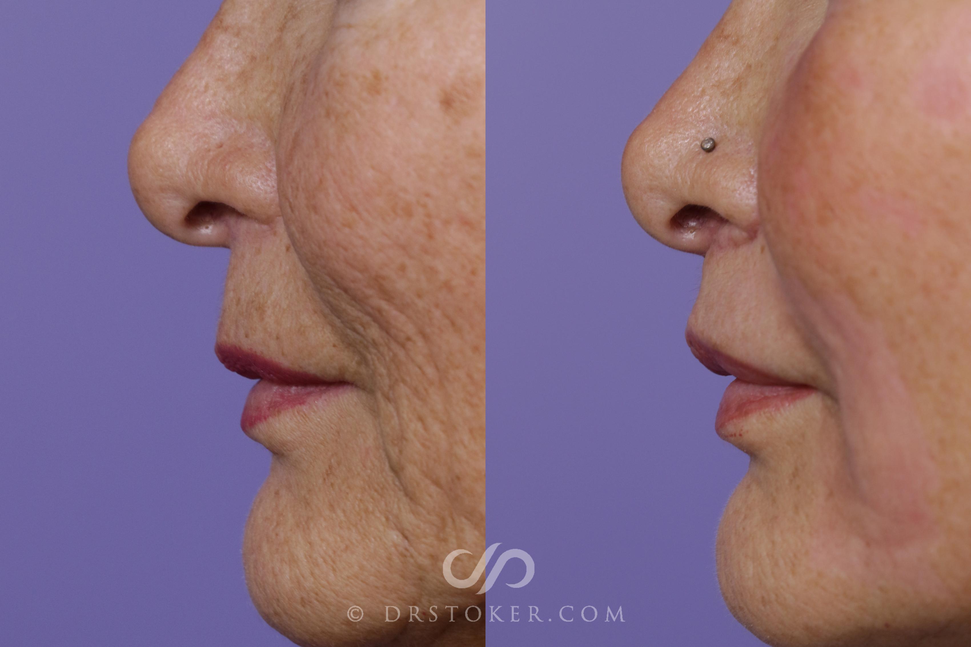 Before & After Lip Lift Case 1672 View #1 View in Los Angeles, CA