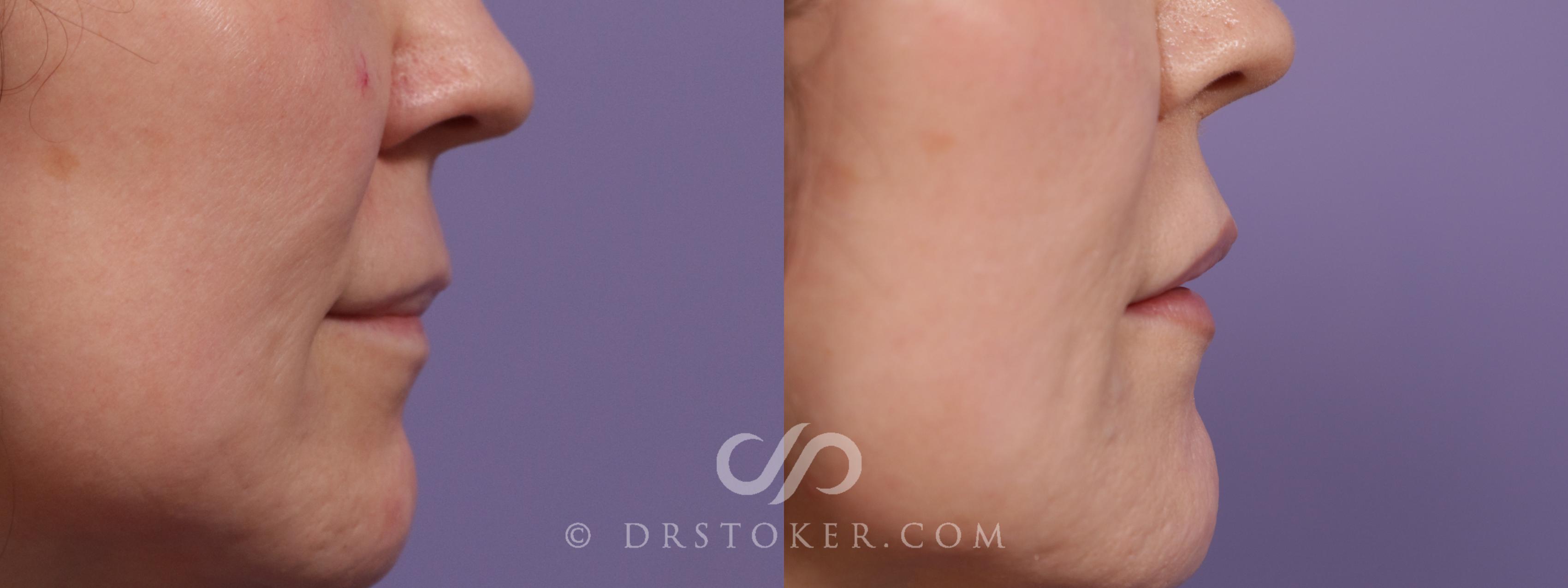 Before & After Lip Lift Case 1952 Right Side View in Los Angeles, CA