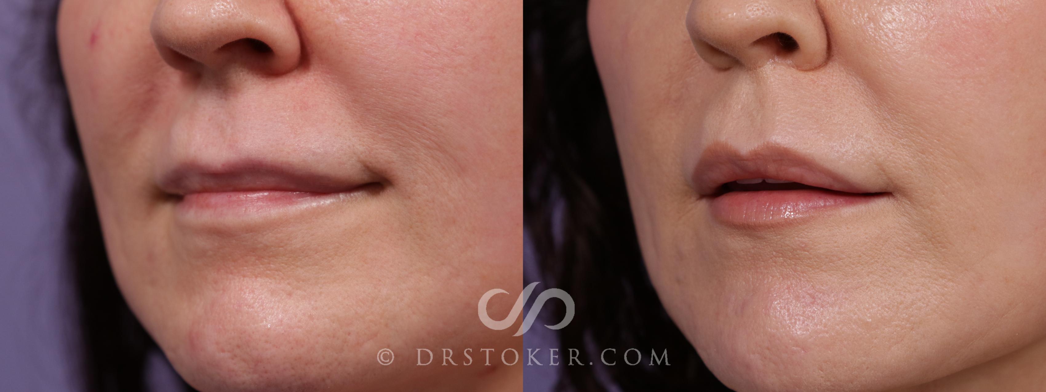 Before & After Lip Lift Case 1953 Left Oblique View in Los Angeles, CA