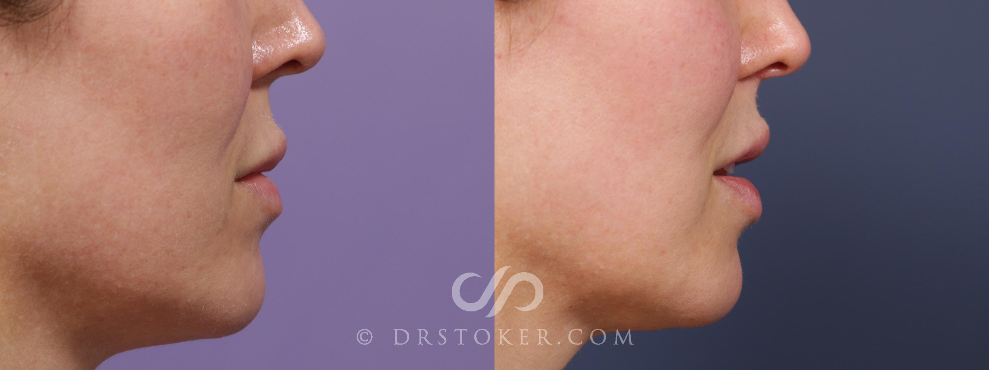 Before & After Lip Lift Case 2000 Right Side View in Los Angeles, CA