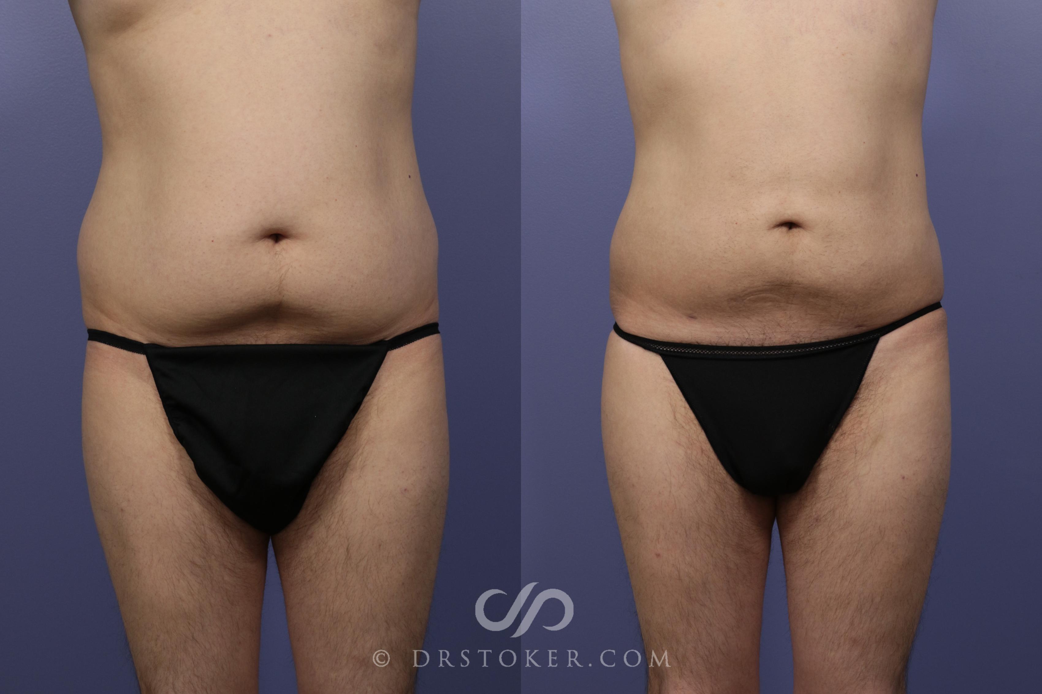 Before & After Liposuction for Men Case 1083 View #1 View in Los Angeles, CA
