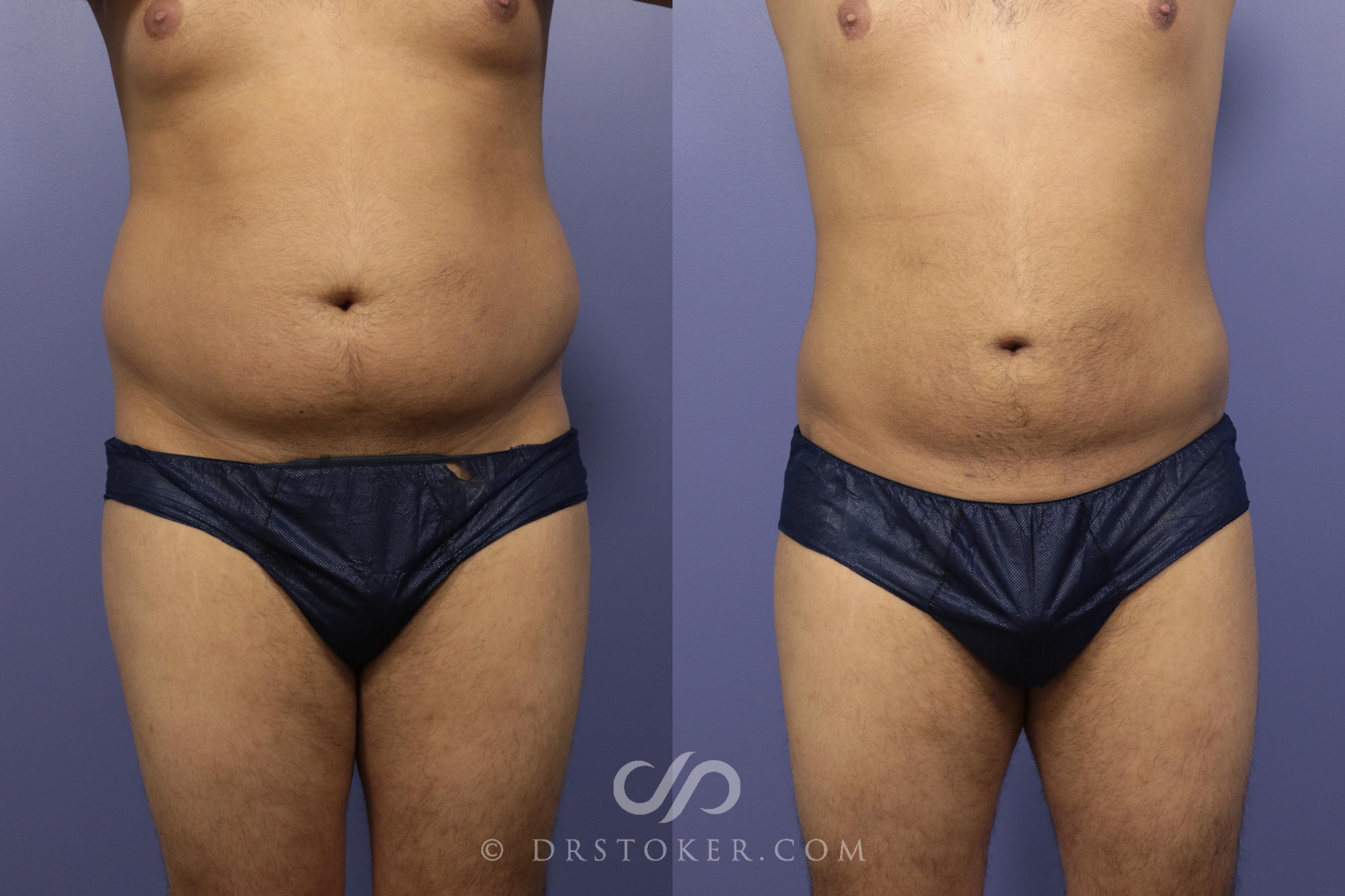 Before & After Liposuction for Men Case 1086 View #1 View in Los Angeles, CA