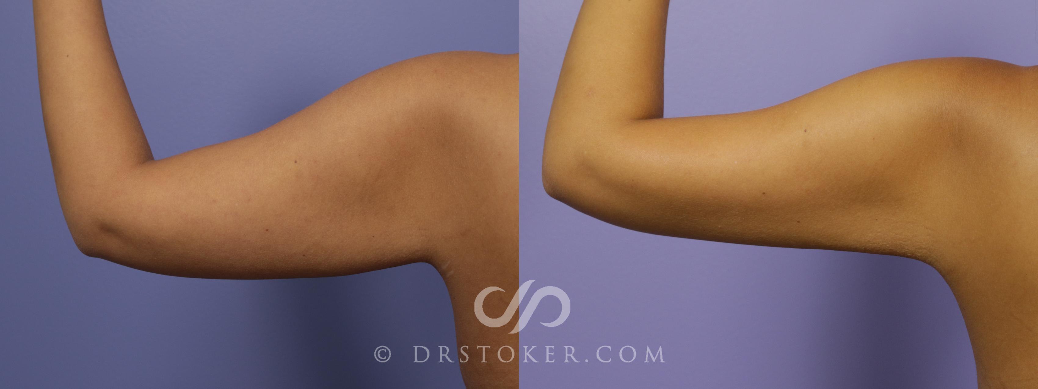 Before & After Liposuction - Axillary Fat Removal Case 1481 View #1 View in Los Angeles, CA