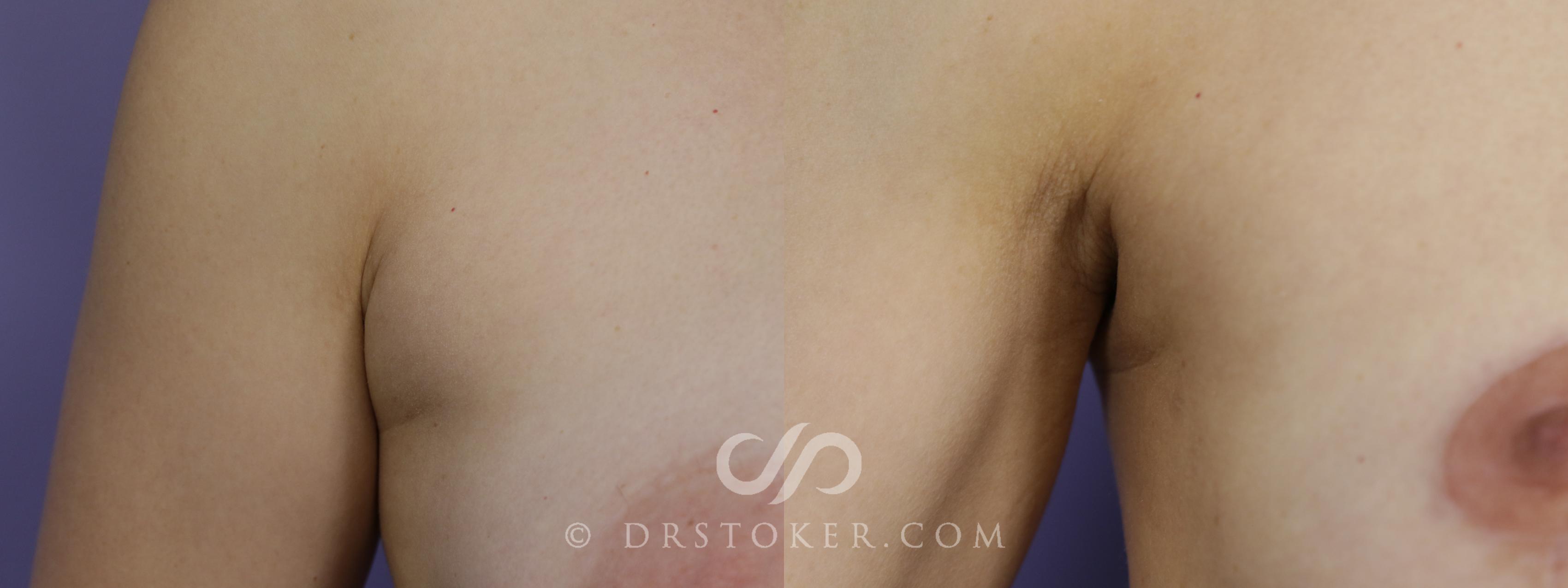 Before & After Liposuction - Axillary Fat Removal Case 1545 View #1 View in Los Angeles, CA
