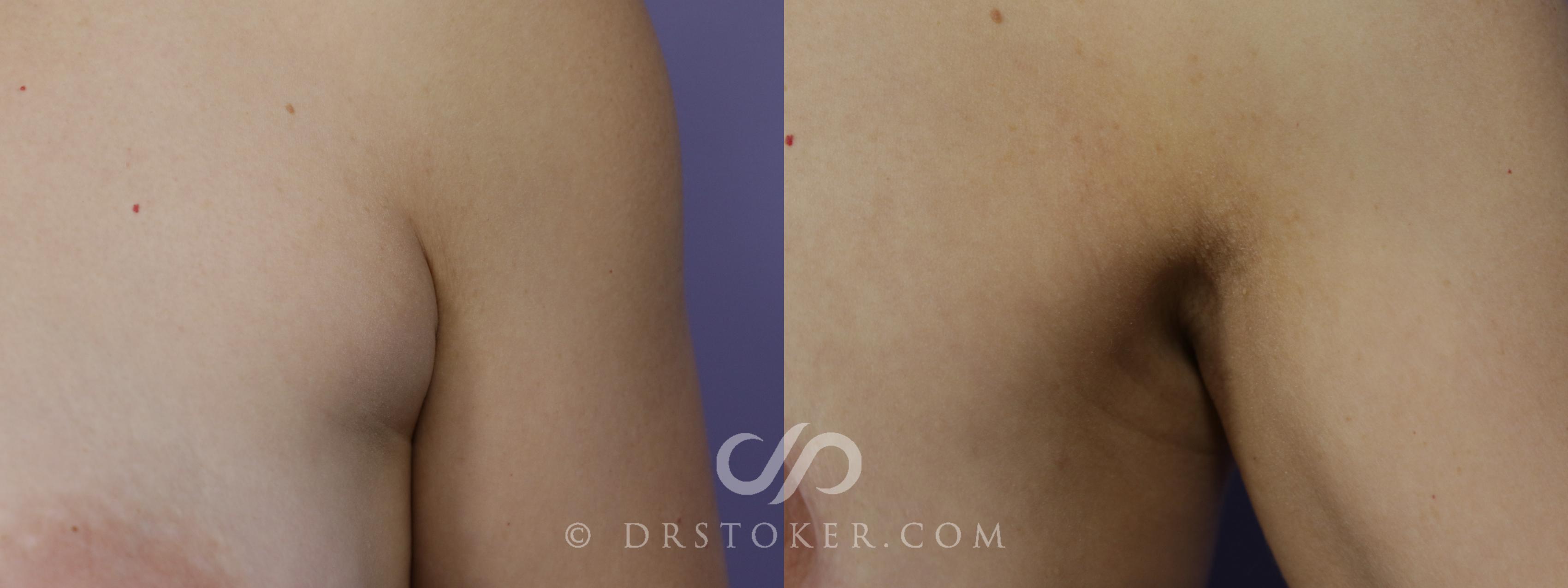 Before & After Liposuction - Axillary Fat Removal Case 1546 View #1 View in Los Angeles, CA