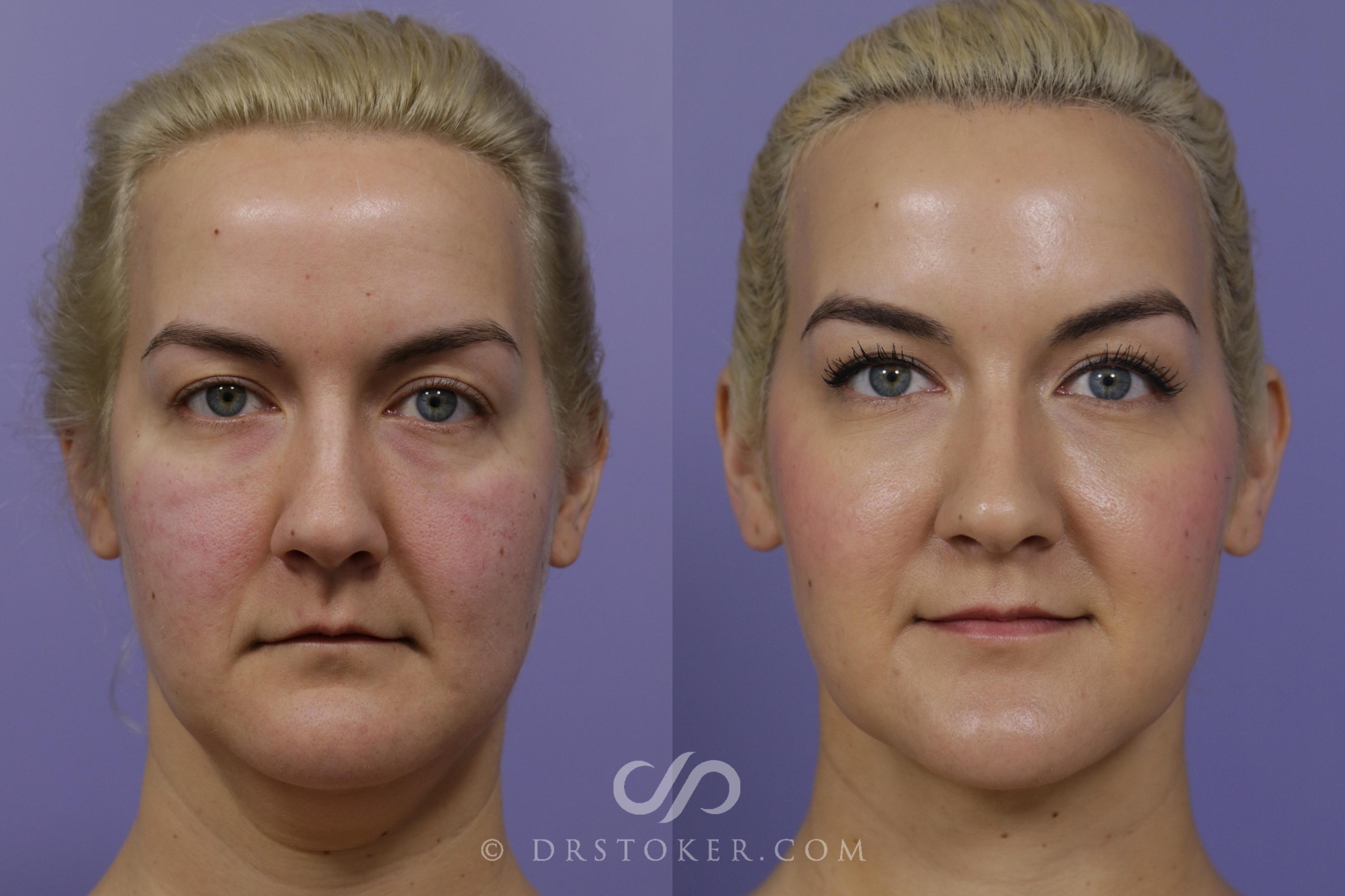 Before & After Liposuction - Neck Case 1461 View #1 View in Los Angeles, CA