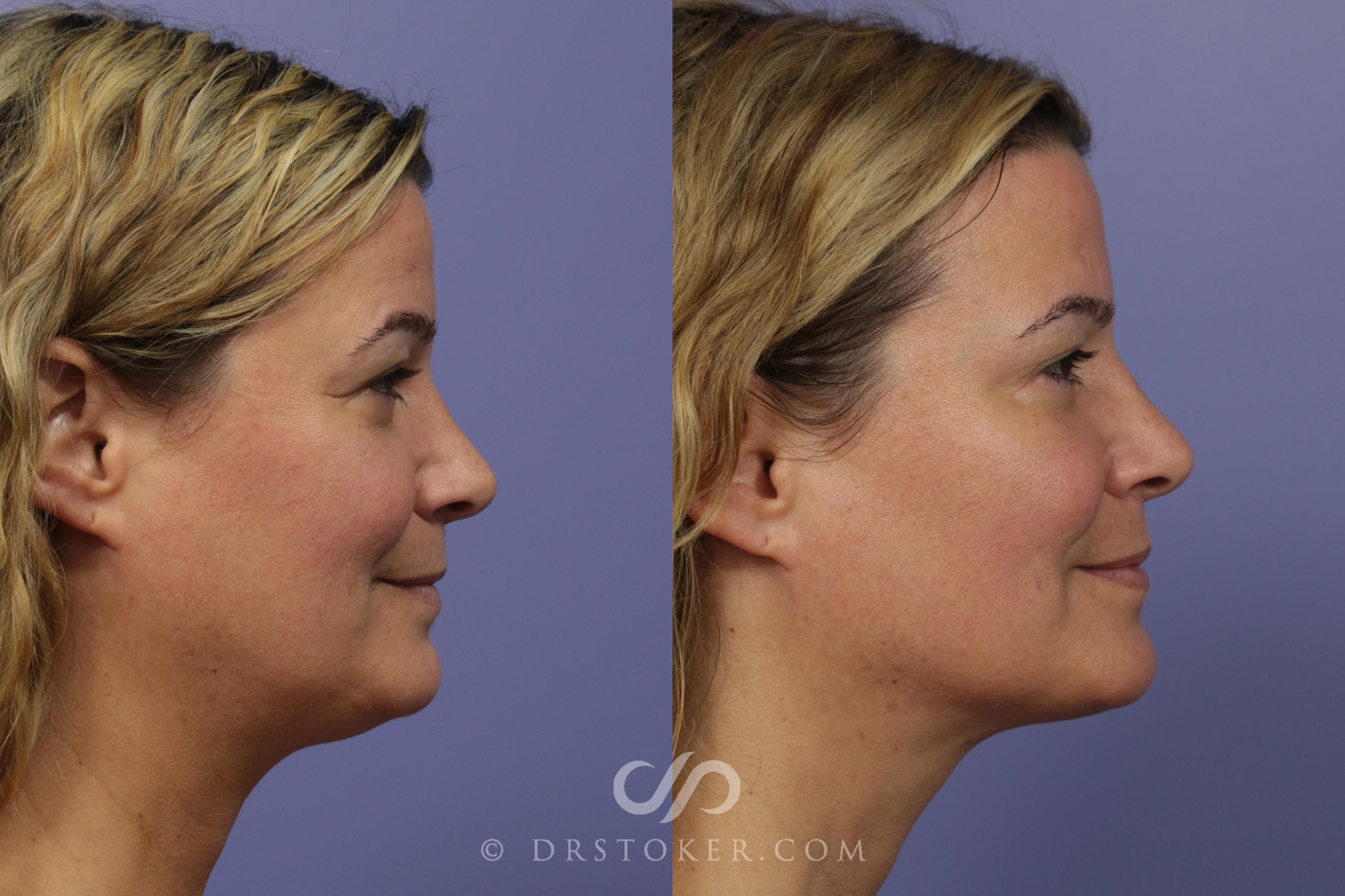 Before & After Liposuction - Neck Case 993 View #1 View in Los Angeles, CA