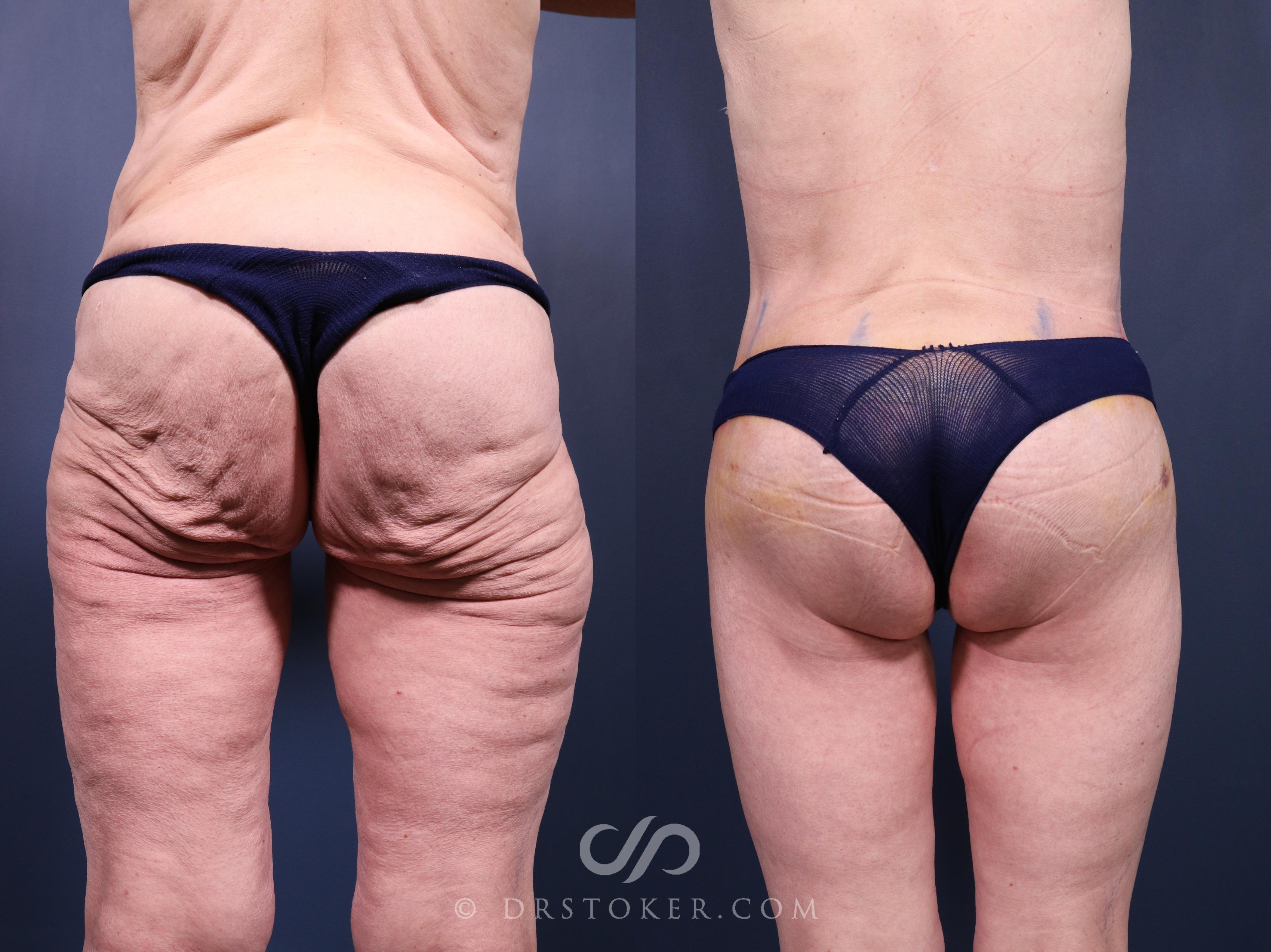 Before & After Bikini Body Lift Case 2381 Back View in Los Angeles, CA