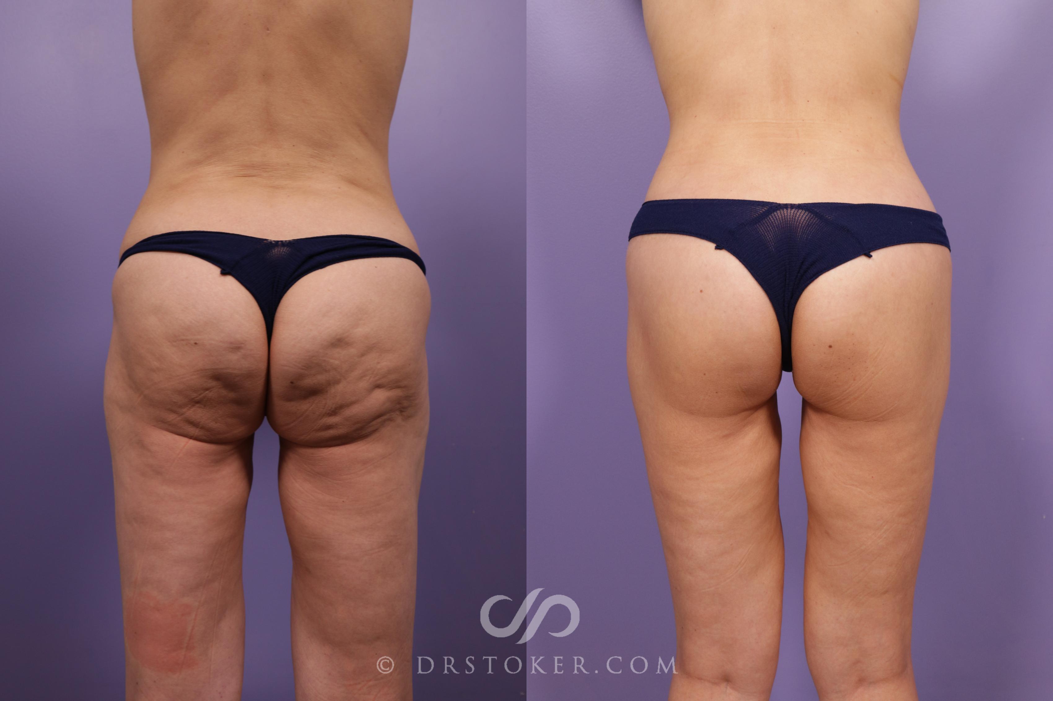 Before & After Buttock Lift (Excisional) Case 2384 Back View in Los Angeles, CA
