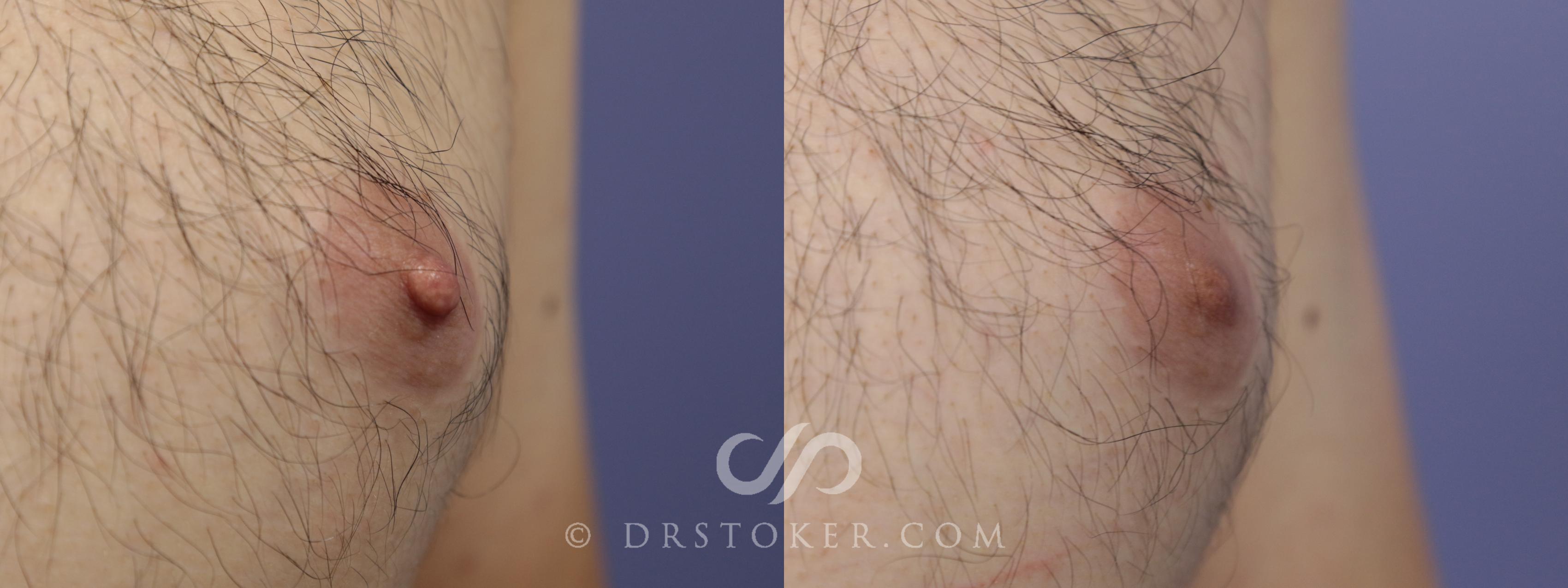 Before & After Nipple - Reduction Case 1223 View #1 View in Los Angeles, CA