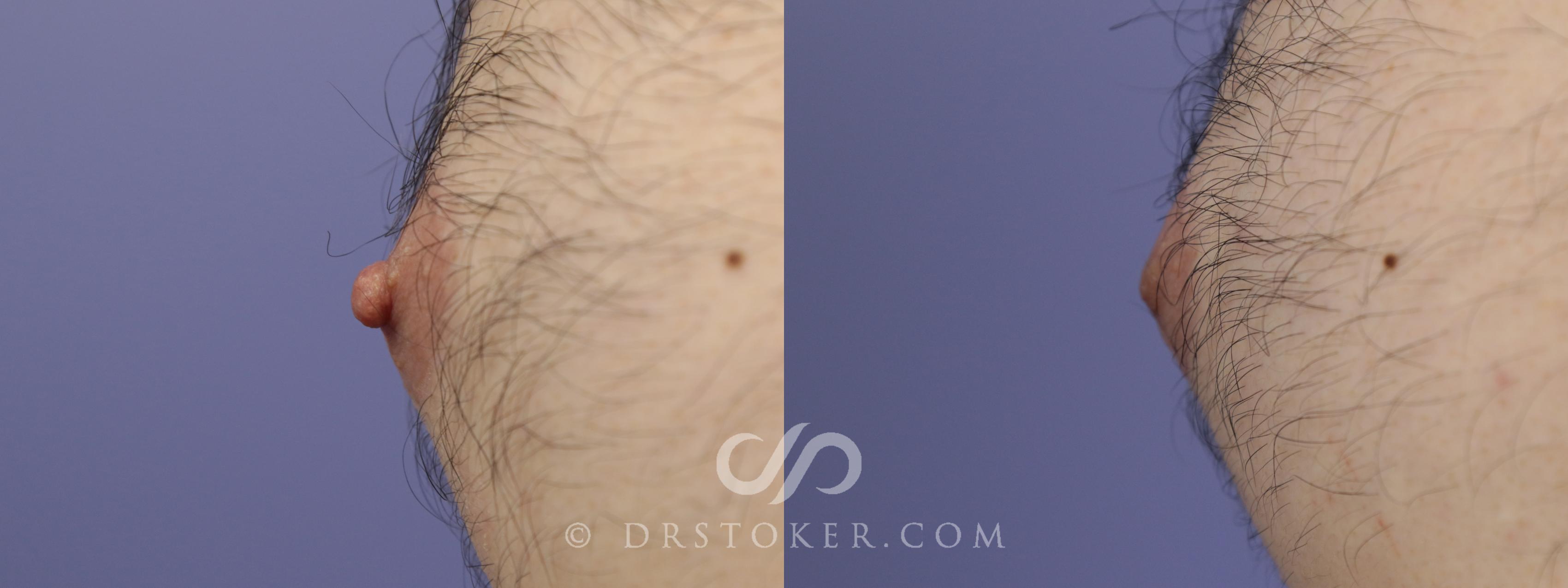 Before & After Nipple - Reduction Case 1229 View #1 View in Los Angeles, CA