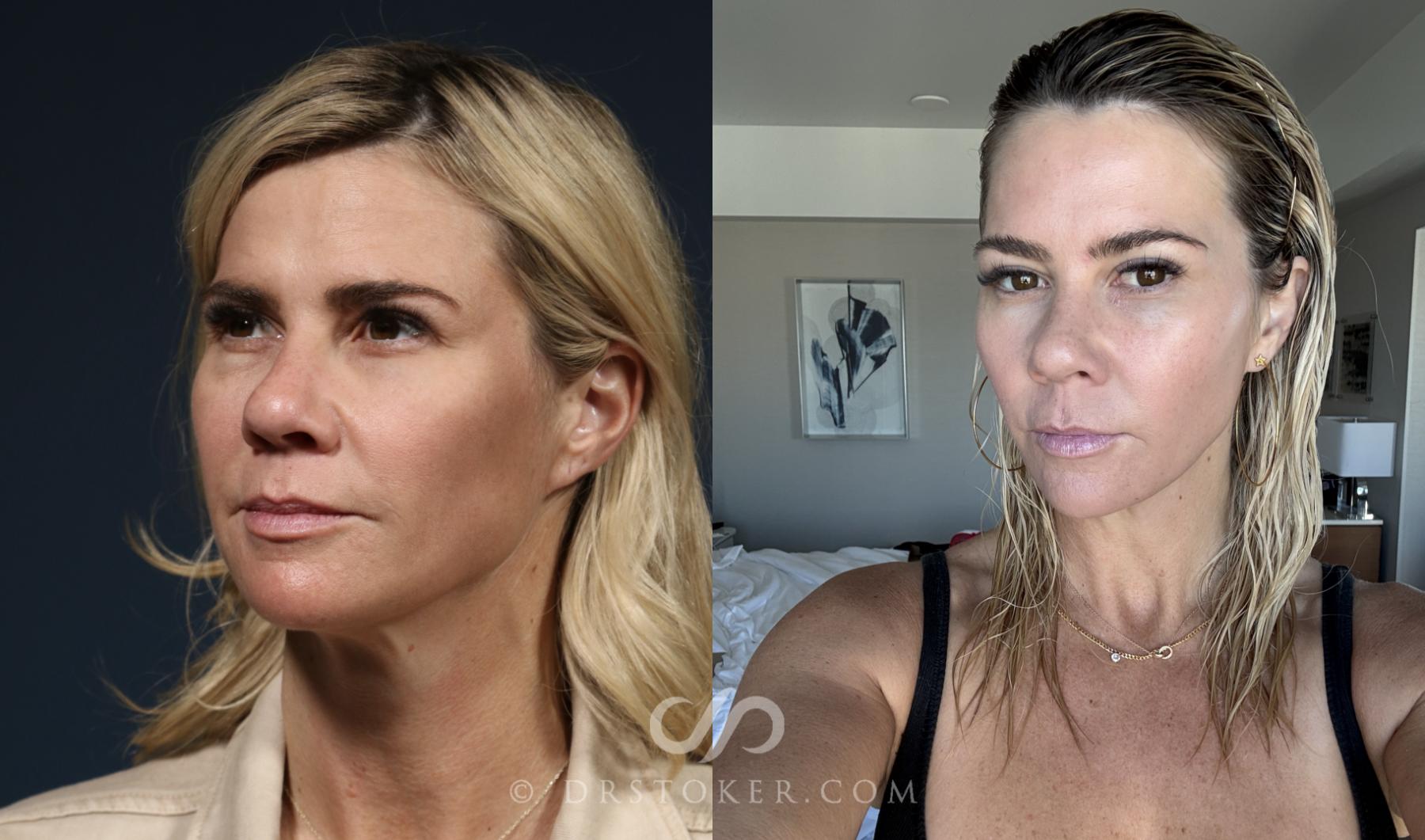 Before & After Microneedling Case 2627 Left Oblique View in Los Angeles, CA