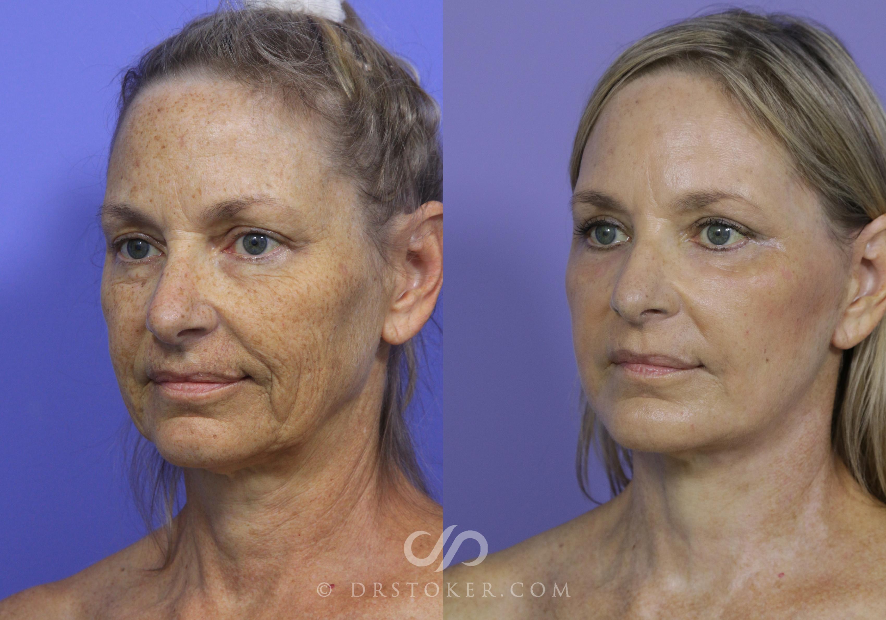 Before & After Neck Lift - Traceless Neck Lift  Case 806 View #1 View in Los Angeles, CA