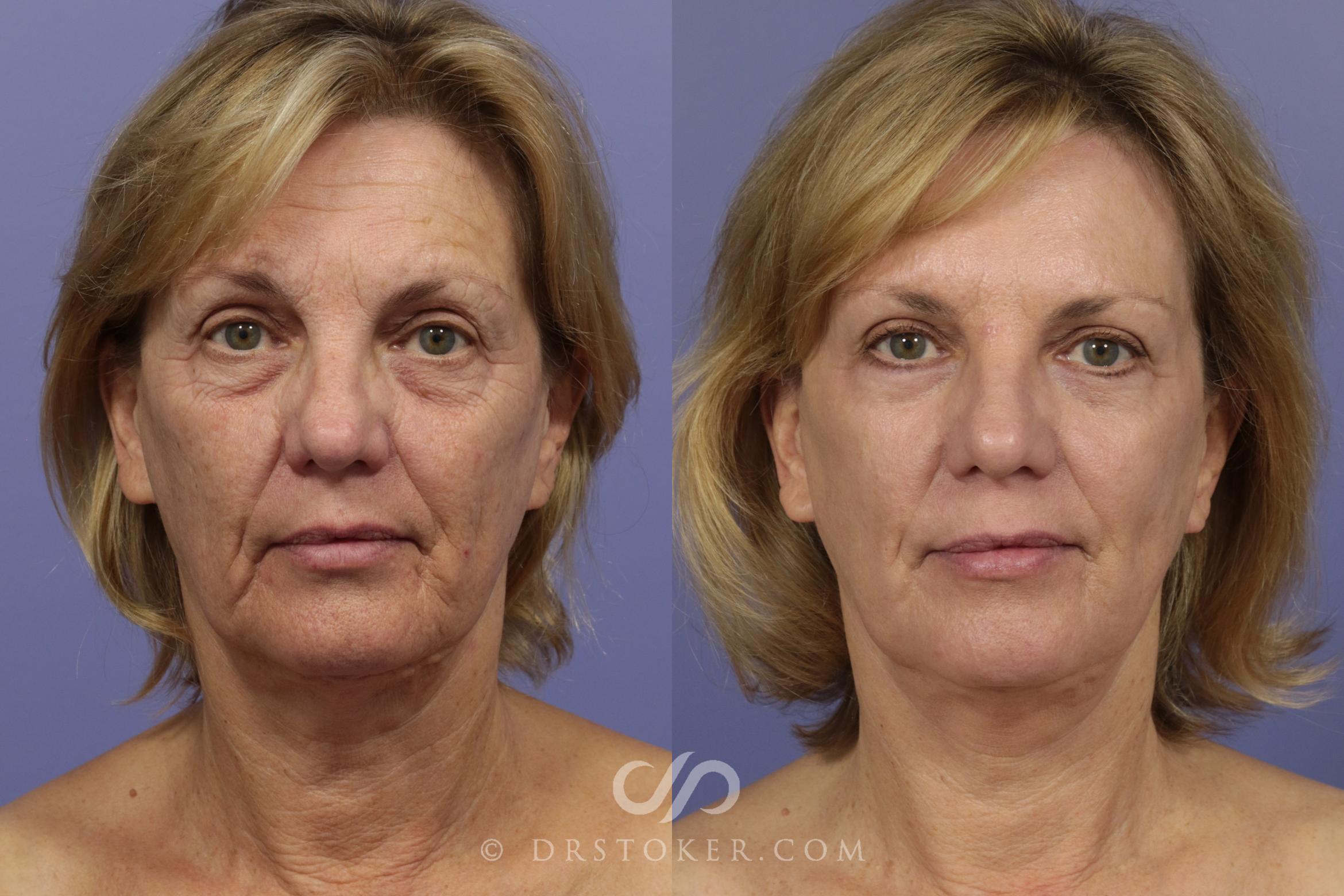 Before & After Neck Lift - Traceless Neck Lift Case 822 View #1 View in Los Angeles, CA