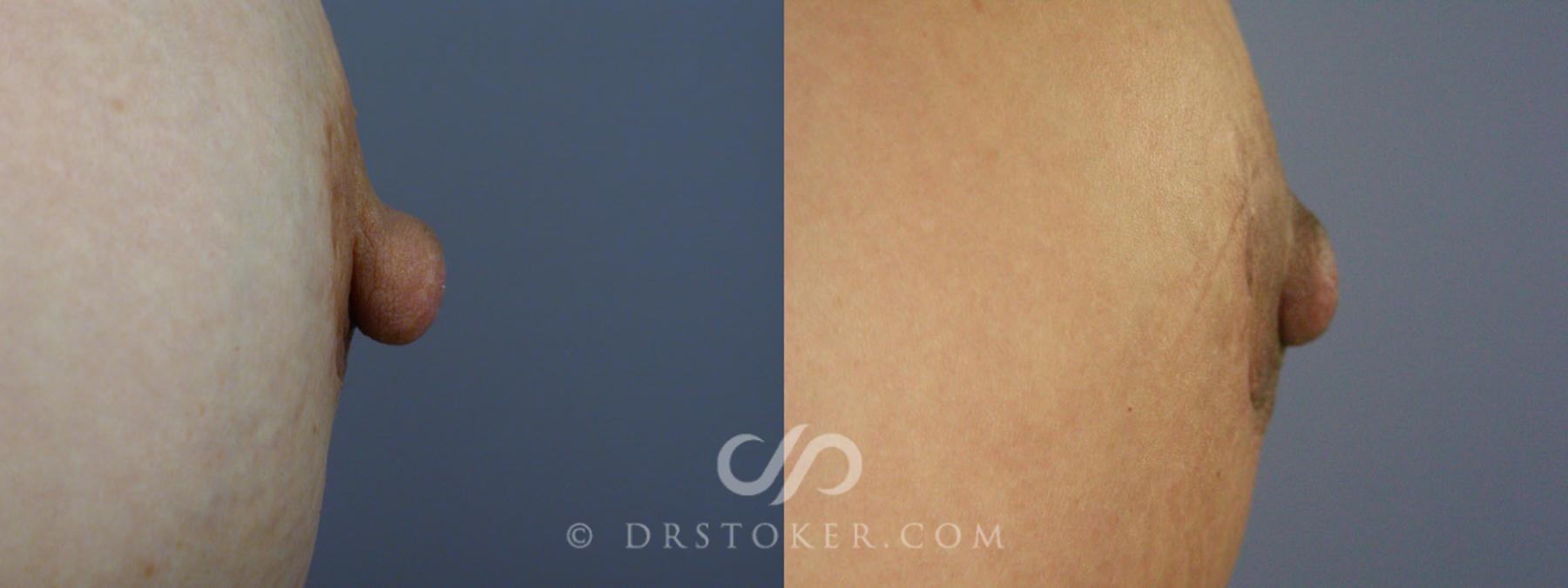 Before & After Nipple - Reduction Case 229 View #2 View in Los Angeles, CA