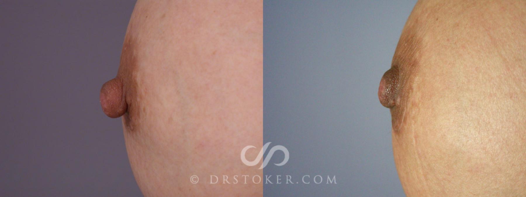 Before & After Nipple - Reduction Case 229 View #3 View in Los Angeles, CA