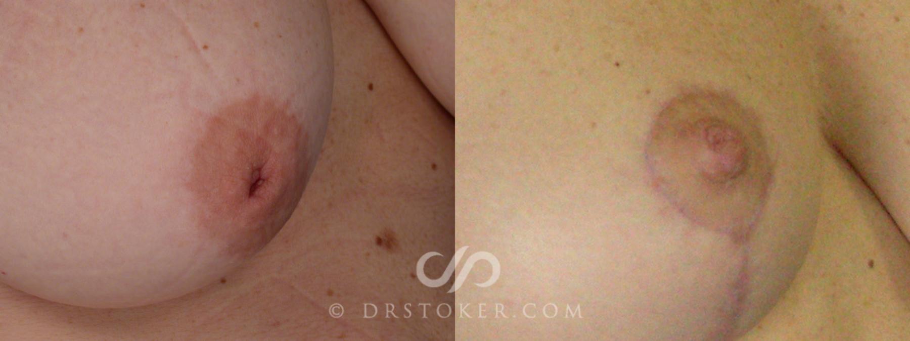 Before & After Nipple - Inversion Correction Case 232 View #2 View in Los Angeles, CA