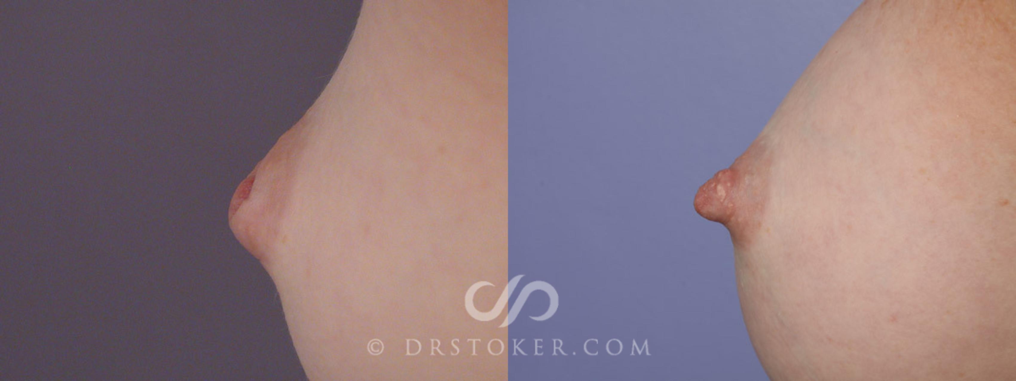 Nipple Inversion Correction Before And After Pictures Case Los