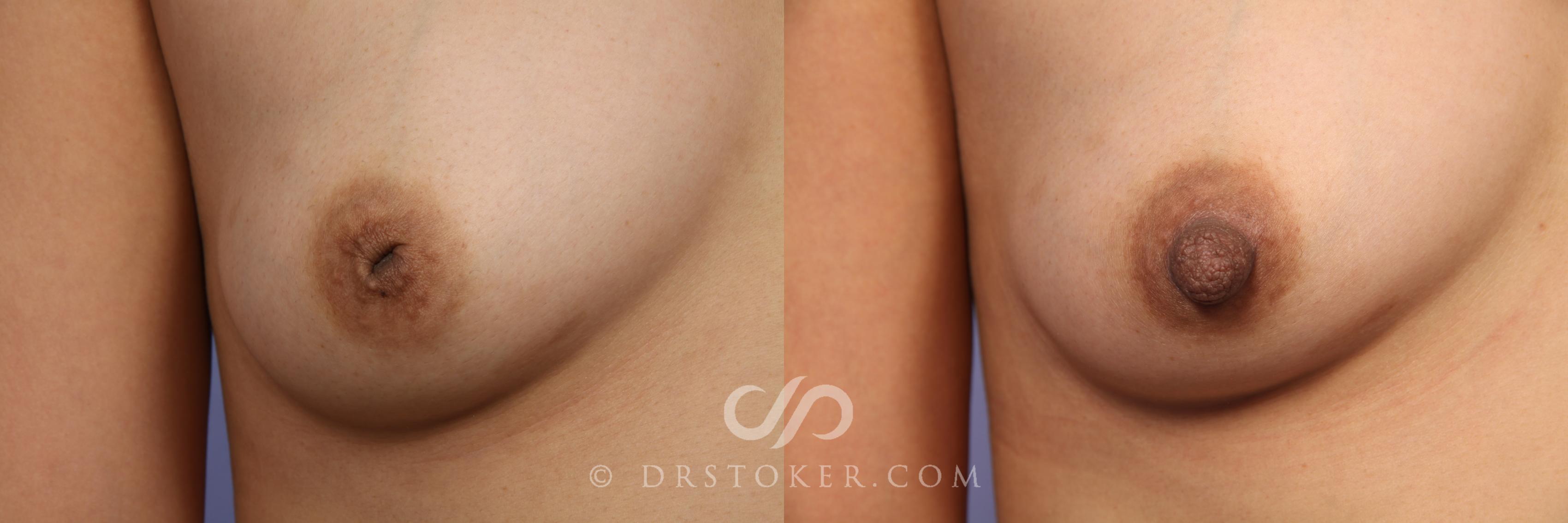 Before & After Nipple - Inversion Correction Case 492 View #1 View in Los Angeles, CA