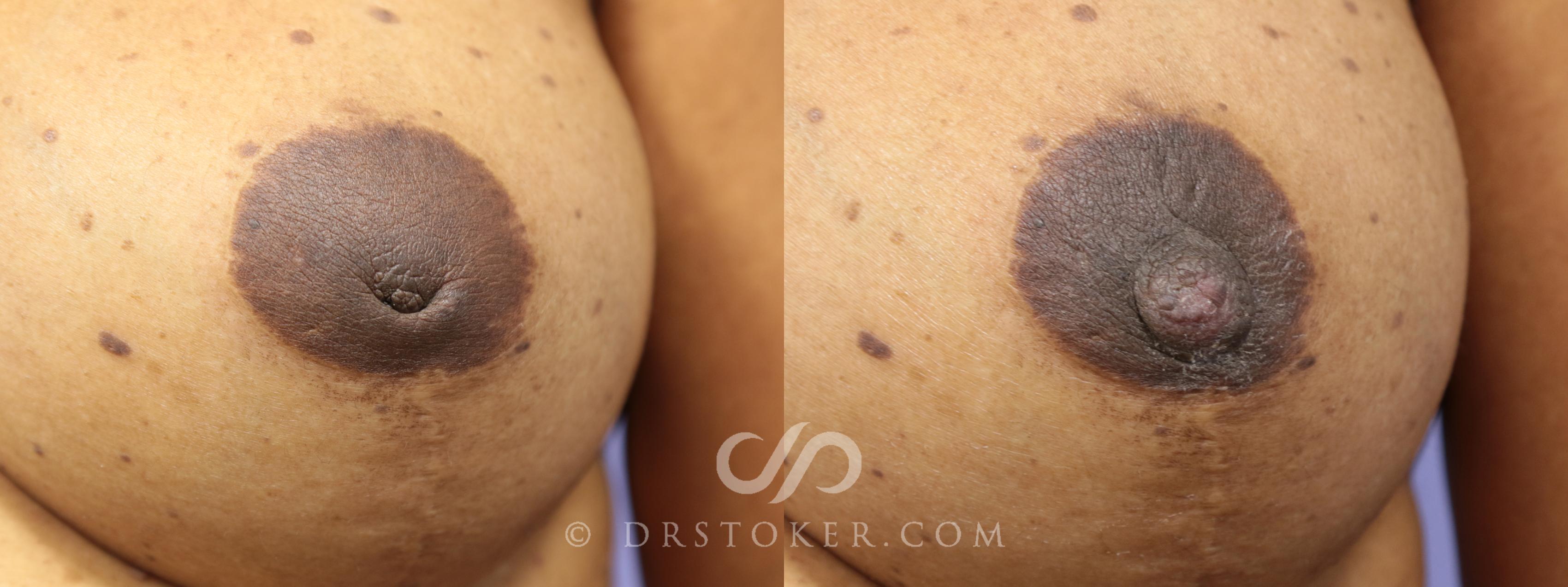 Before & After Nipple - Inversion Correction Case 750 View #1 View in Los Angeles, CA