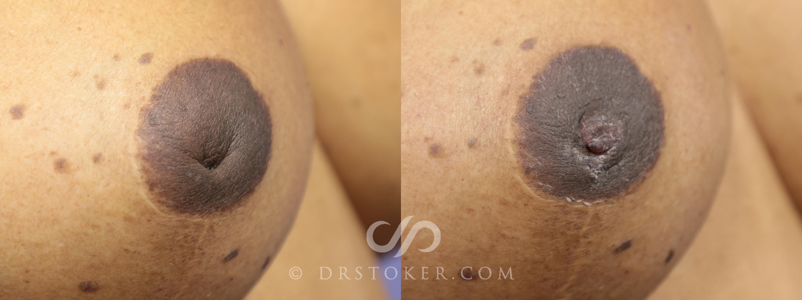 Before & After Nipple - Inversion Correction Case 752 View #1 View in Los Angeles, CA