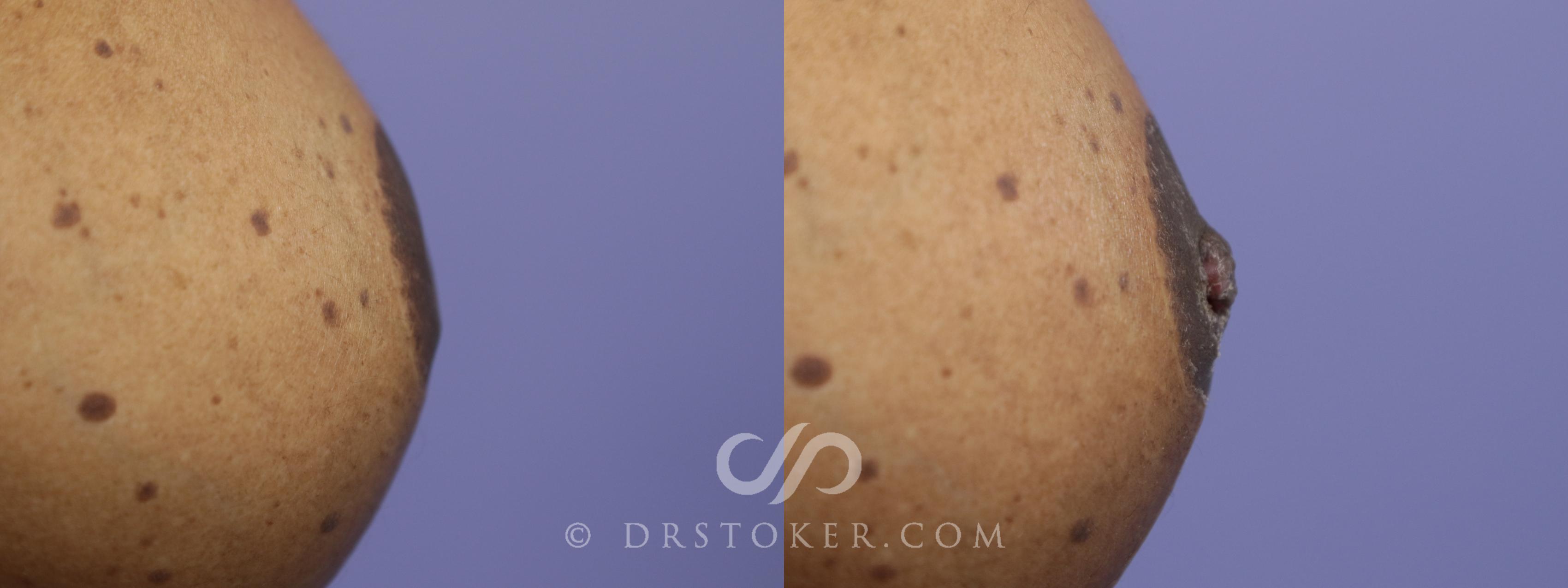 Before & After Nipple - Inversion Correction Case 754 View #1 View in Los Angeles, CA