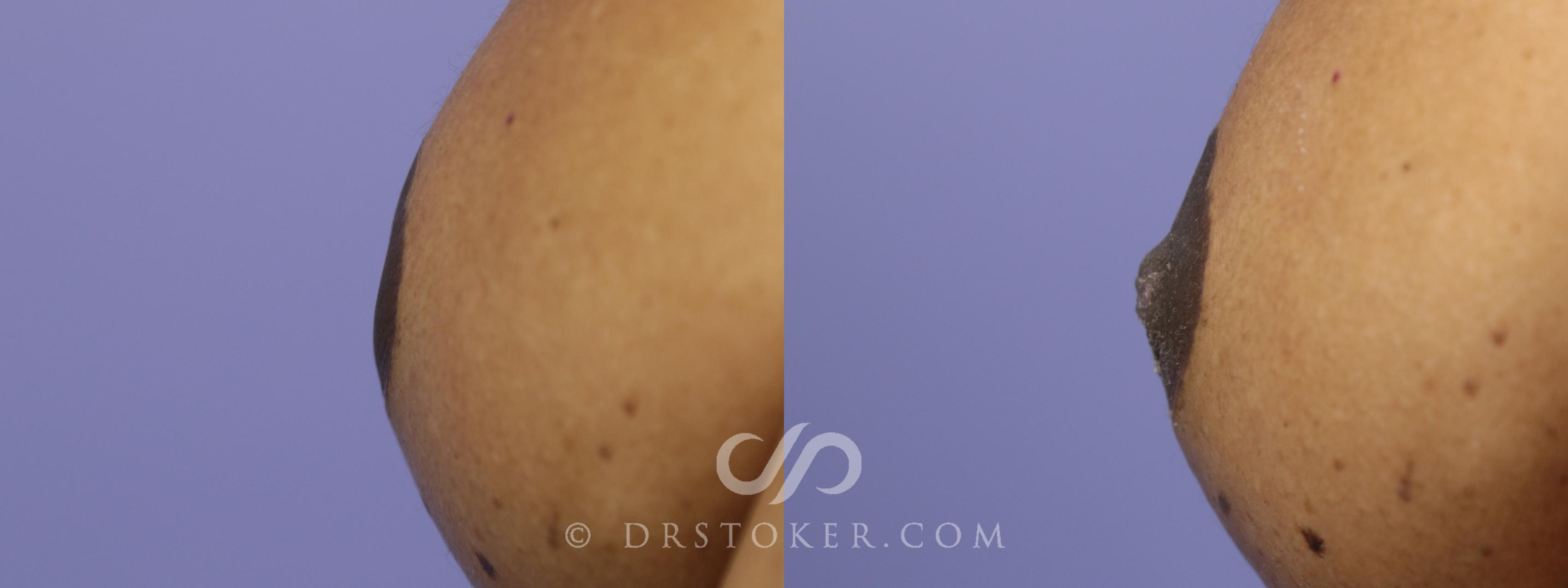 Before & After Nipple - Inversion Correction Case 755 View #1 View in Los Angeles, CA