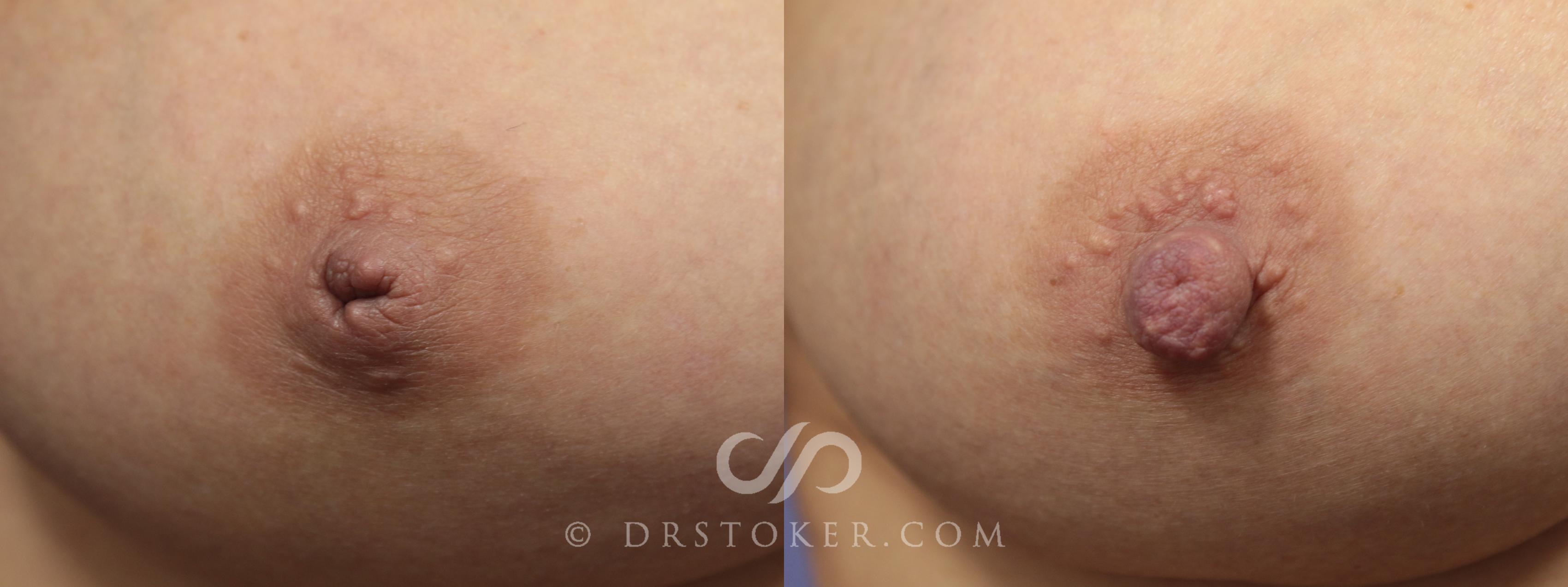 Before & After Nipple - Inversion Correction Case 756 View #1 View in Los Angeles, CA